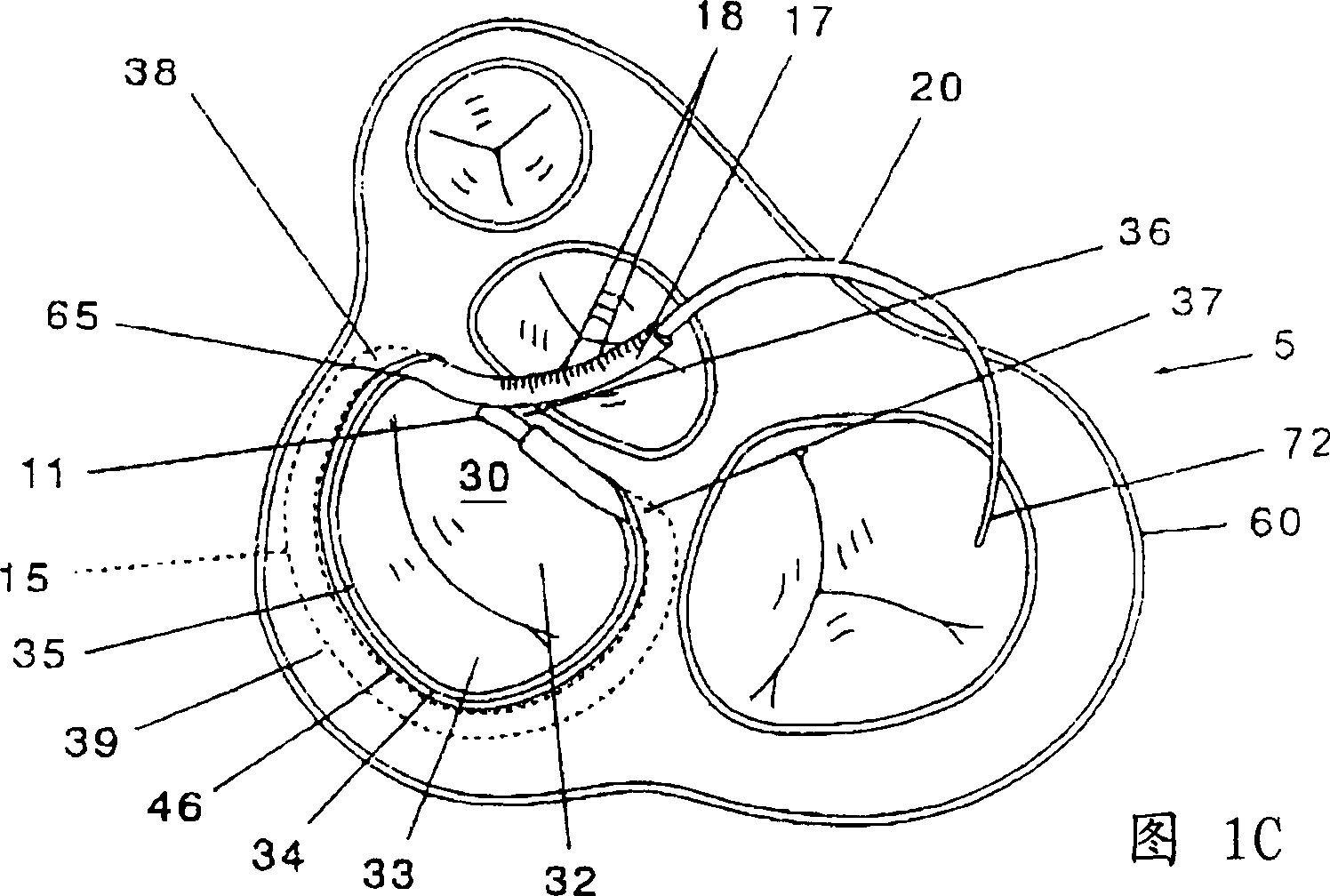 Mitral valve annuloplasty ring and method