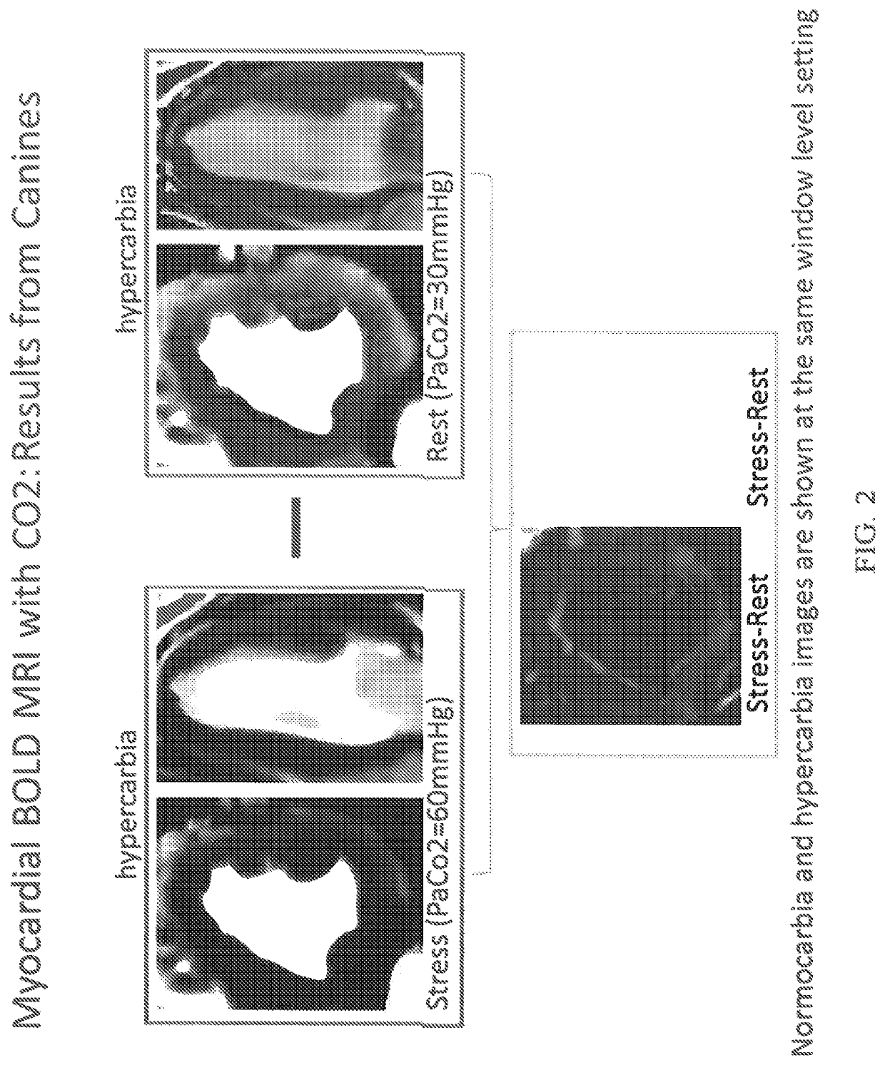 Assessment of coronary heart disease with carbon dioxide