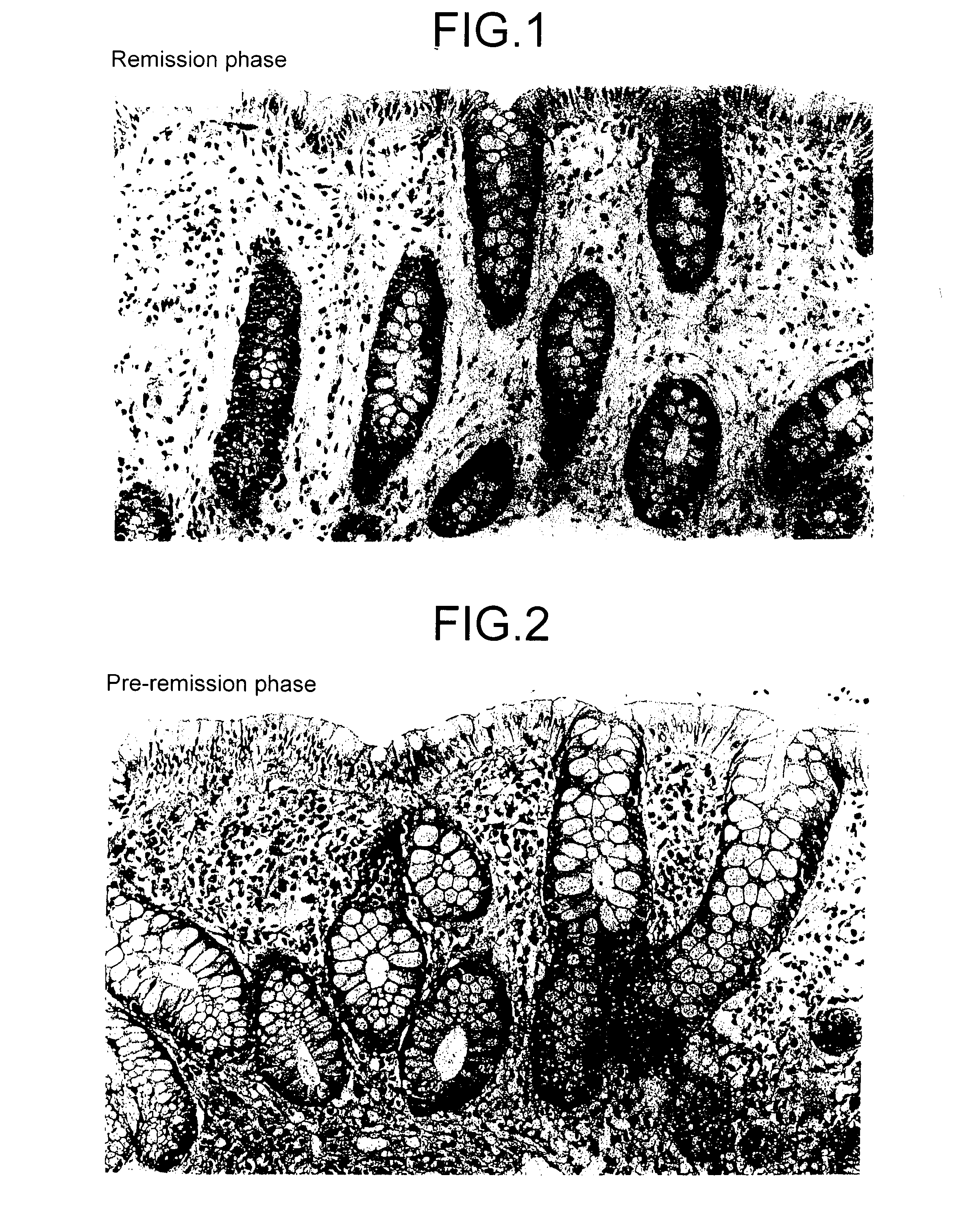 Method for determining the stage of ulcerative colitis or interstitial pneumonitis and reagent kit thereof