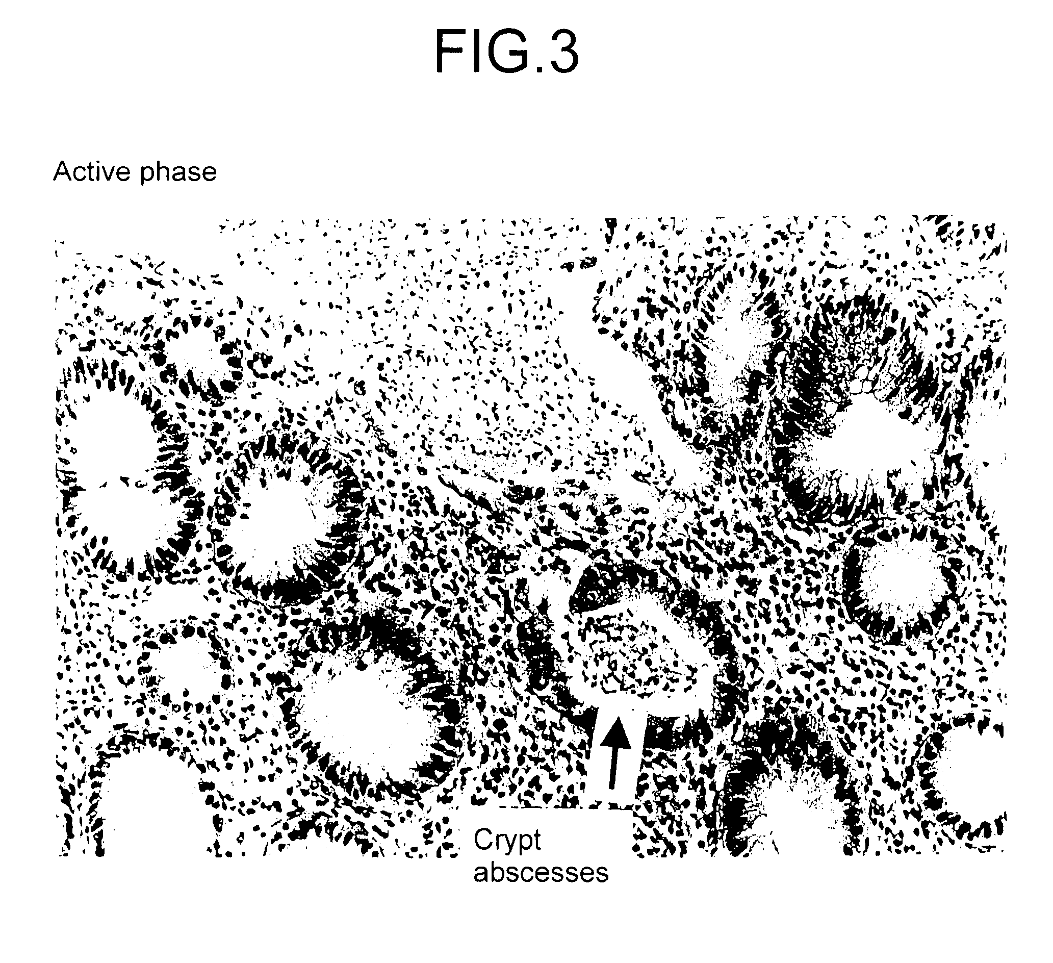 Method for determining the stage of ulcerative colitis or interstitial pneumonitis and reagent kit thereof