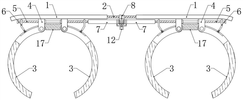 A kind of extravascular stent for kidney transplantation