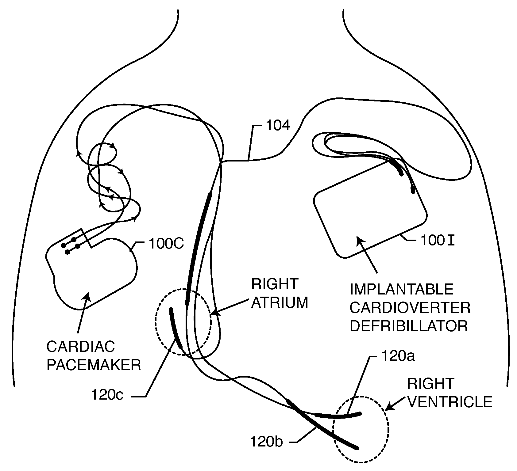 Switch for turning off therapy delivery of an active implantable medical device during MRI scans