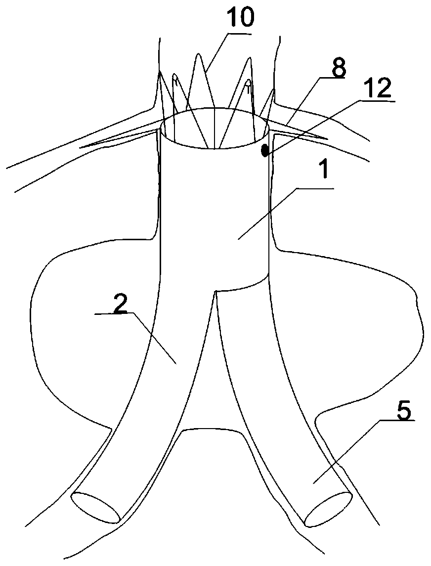 Abdominal aortic aneurysm covered stent