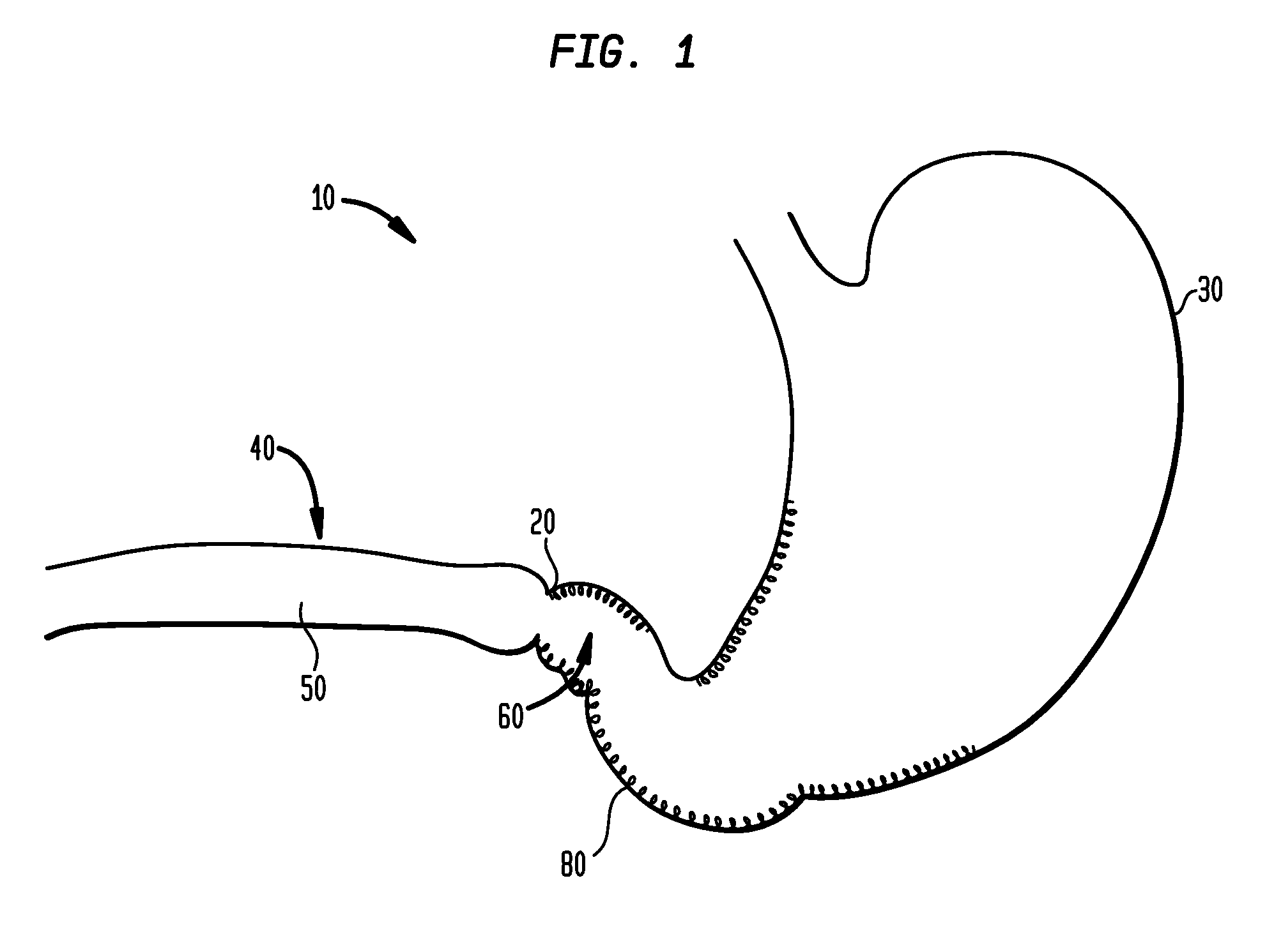 Systems and methods for treating obesity and type 2 diabetes