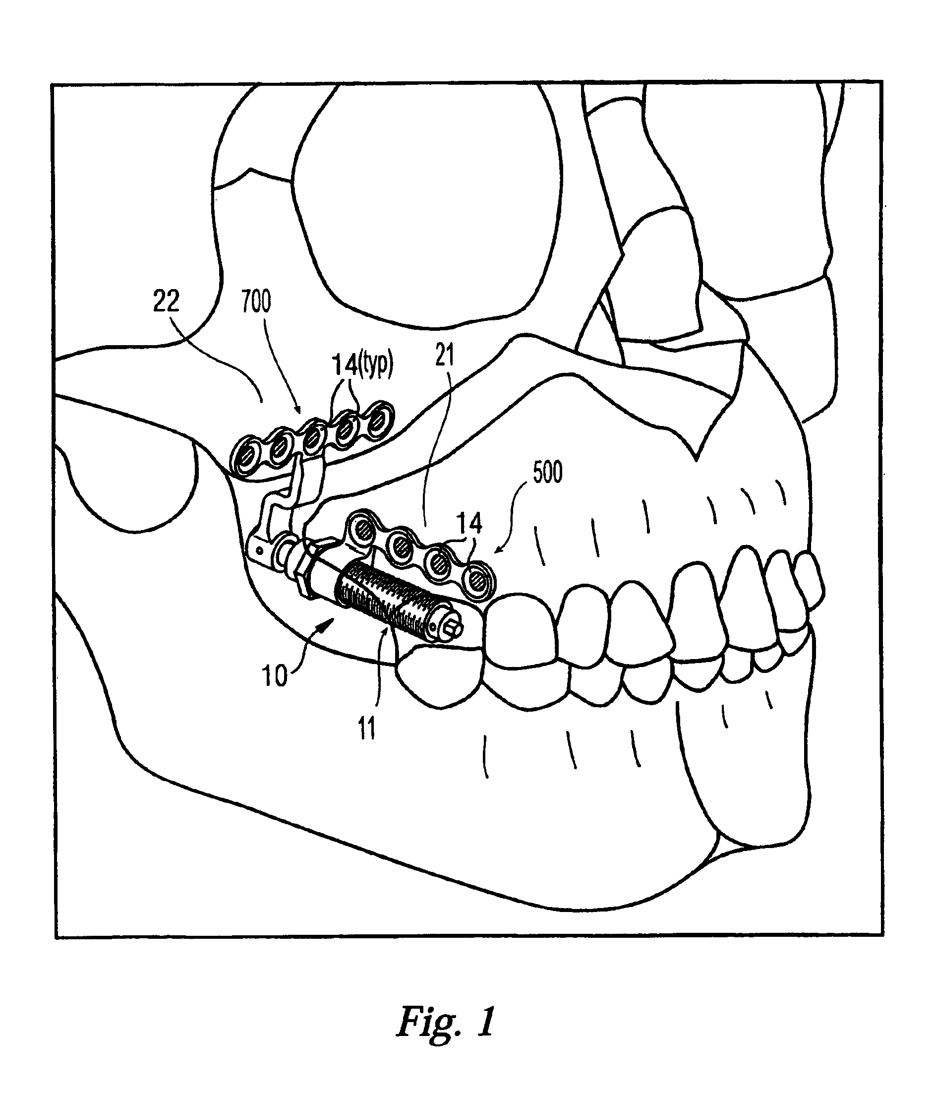 Compact maxillary distractor