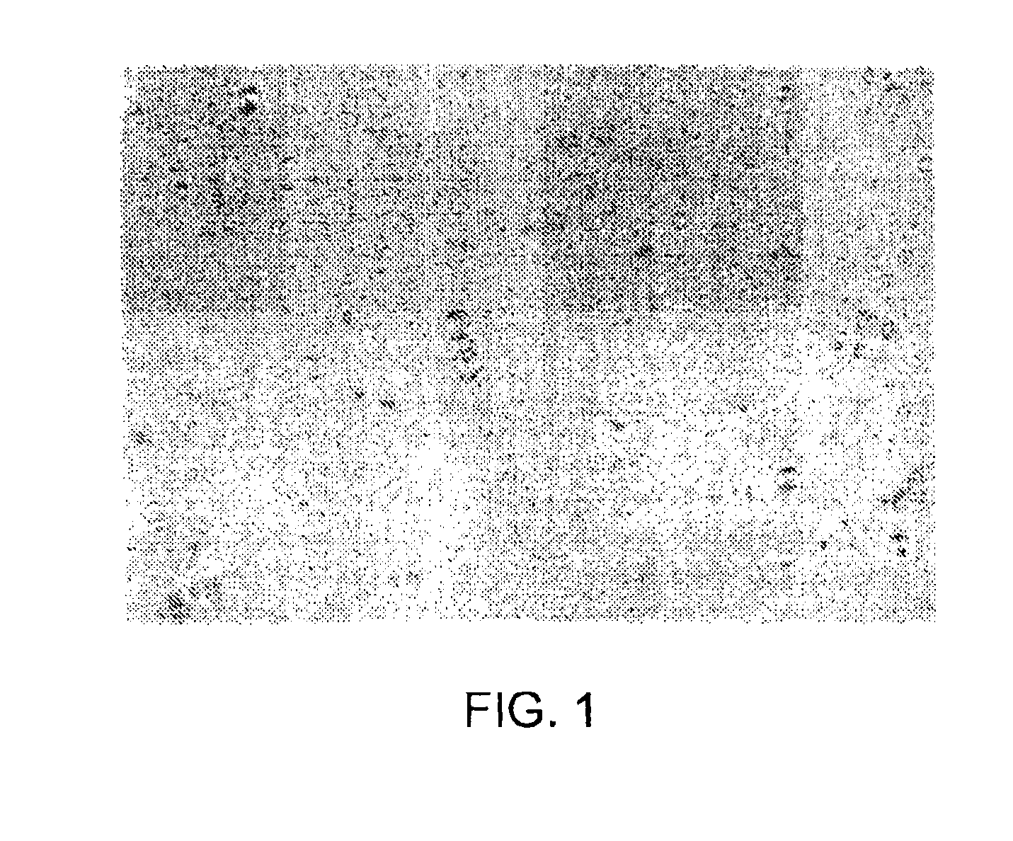 Biphasic lipid-vesicle compositions and methods for treating cervical dysplasia by intravaginal delivery