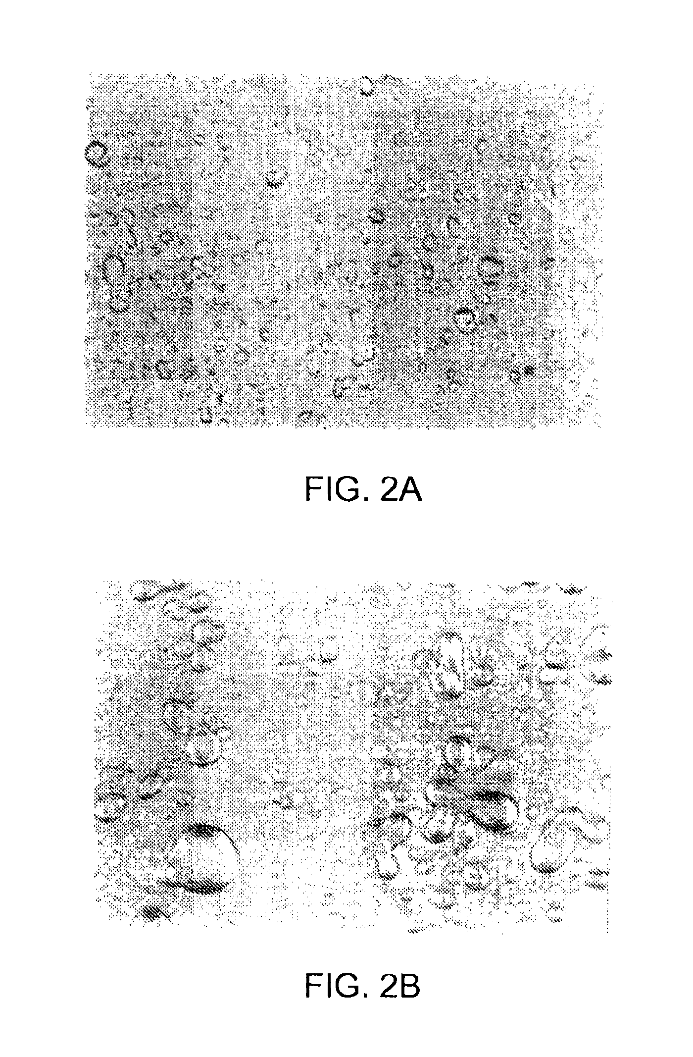 Biphasic lipid-vesicle compositions and methods for treating cervical dysplasia by intravaginal delivery
