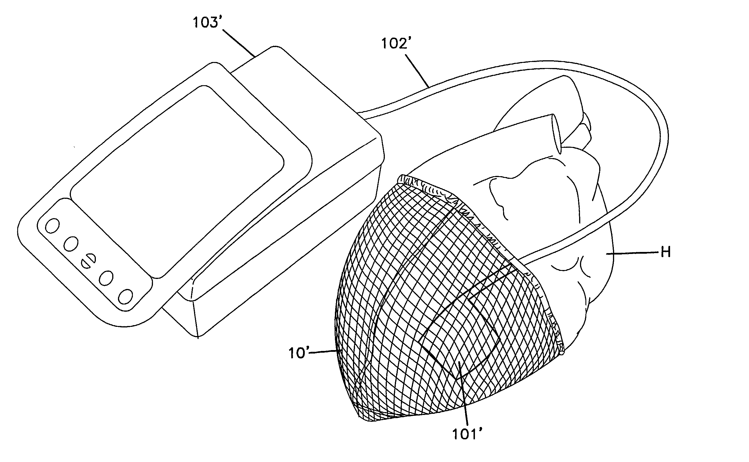 Tension indicator for cardiac support device and method therefore