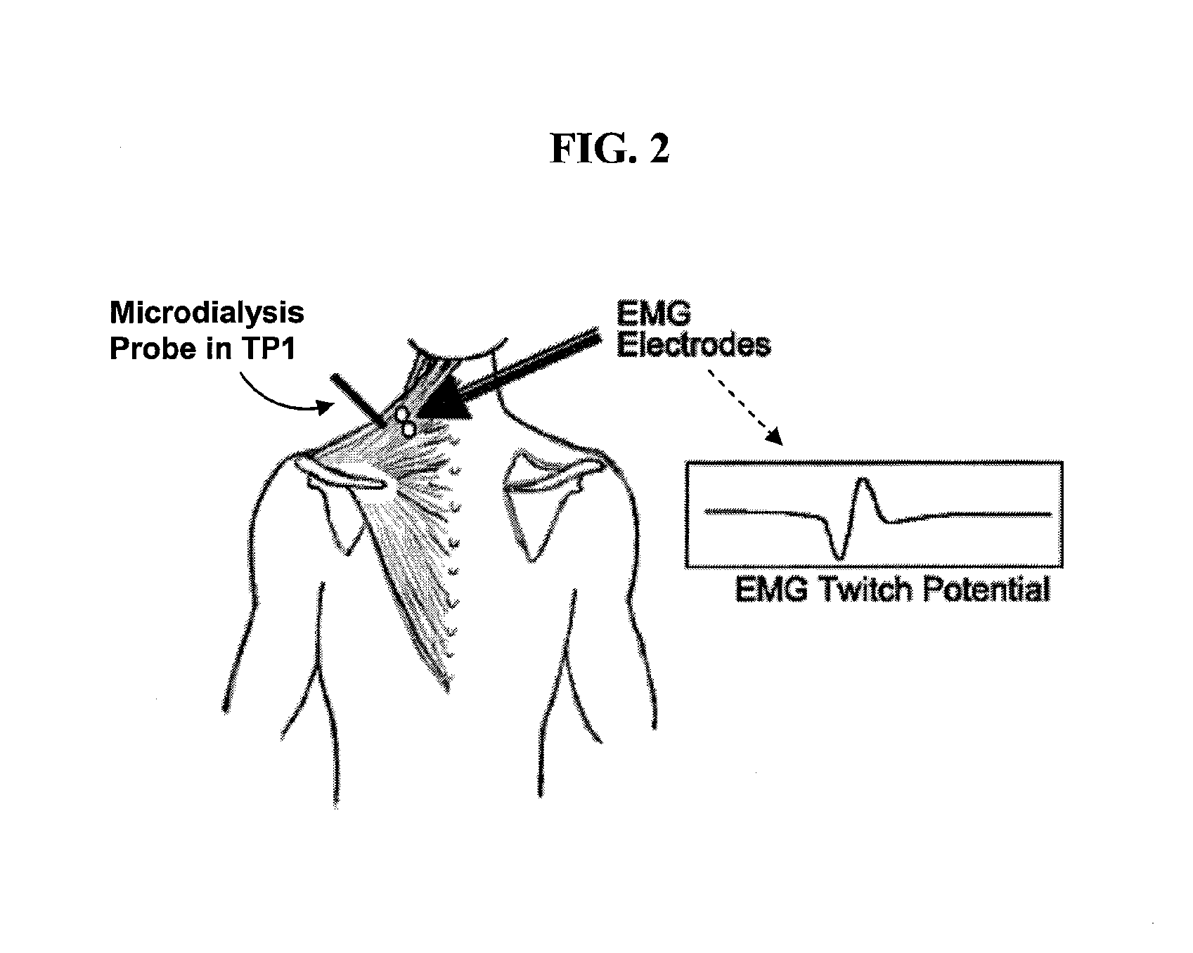 Microdialysis probe