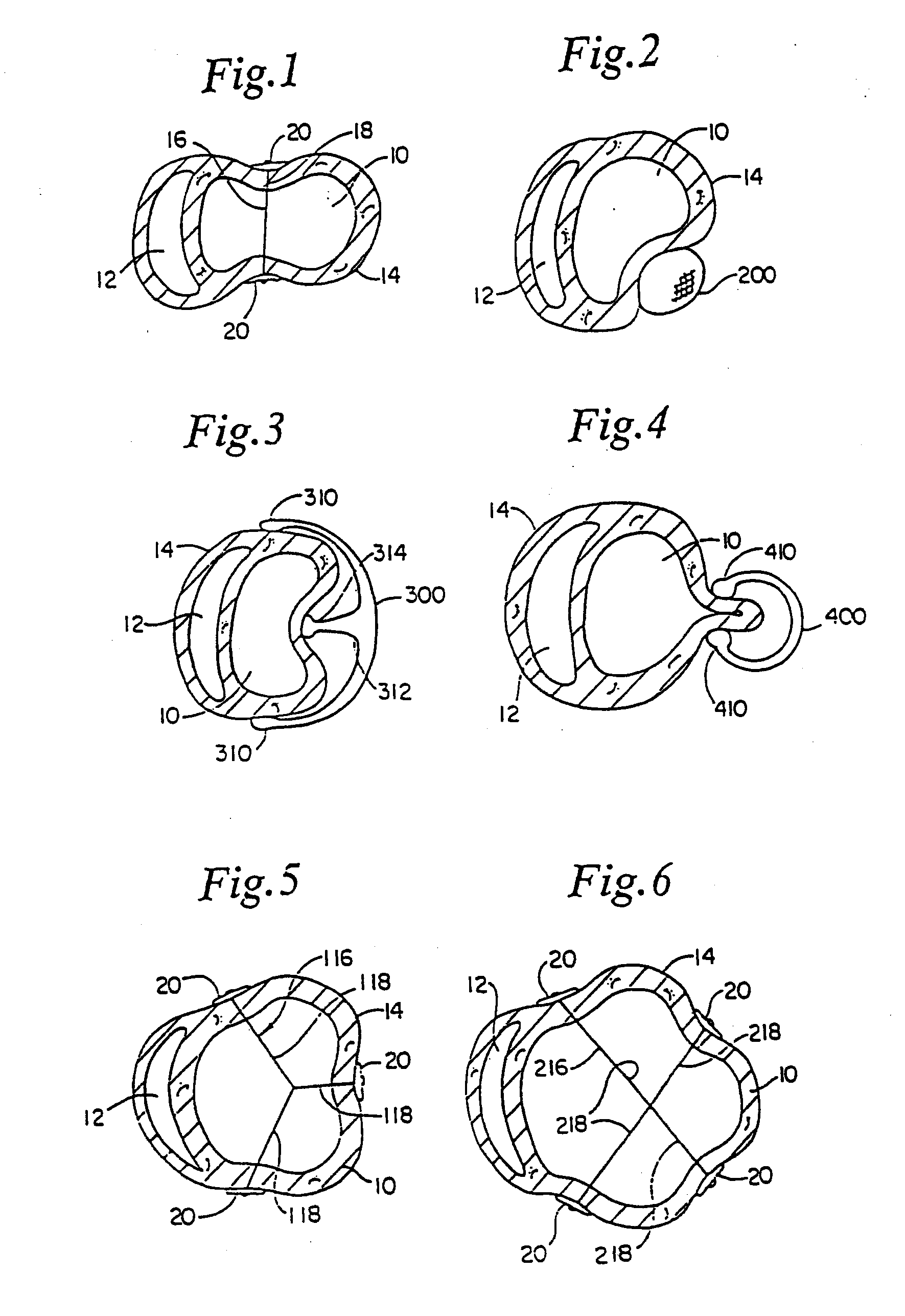 Heart wall tension reduction apparatus