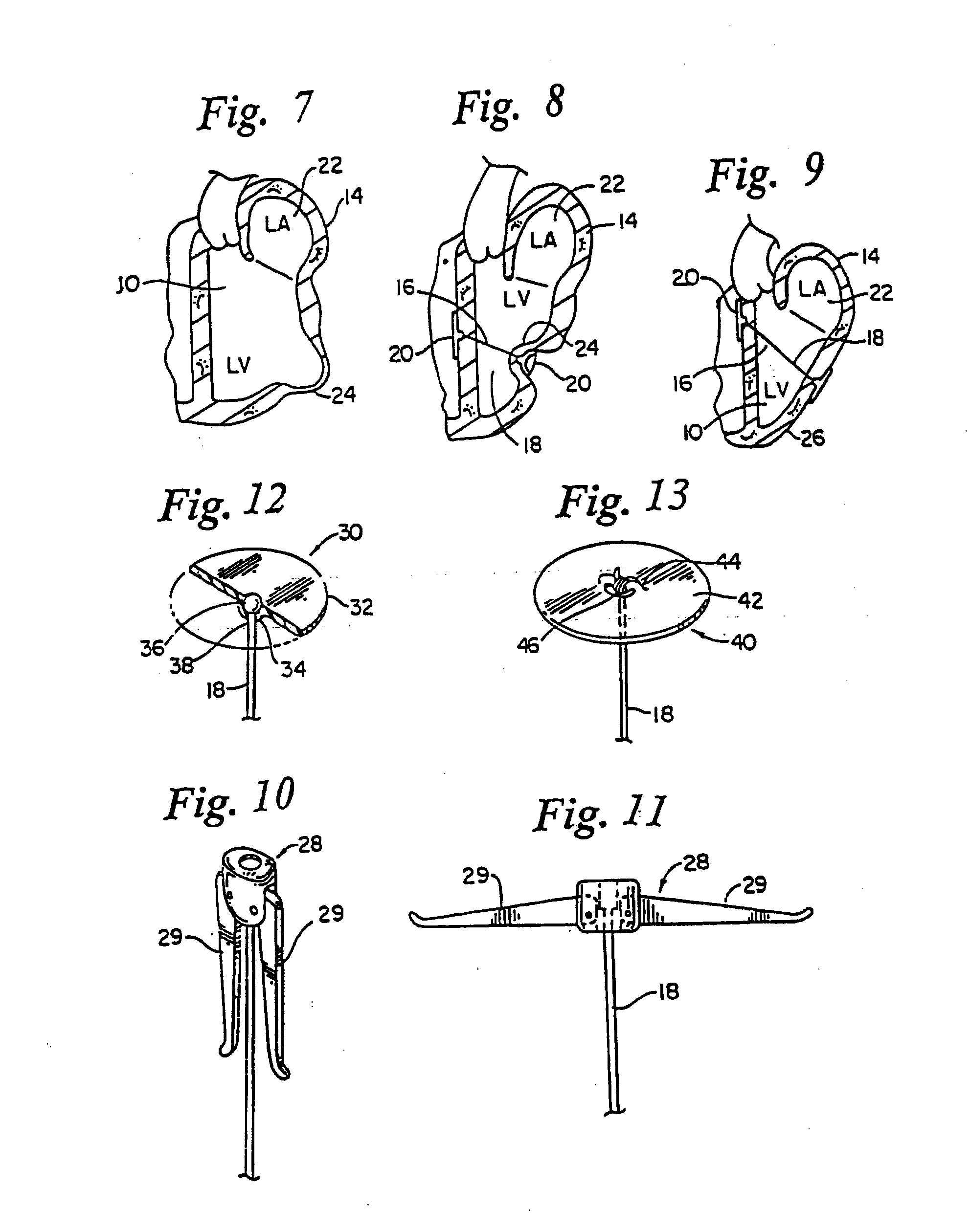 Heart wall tension reduction apparatus