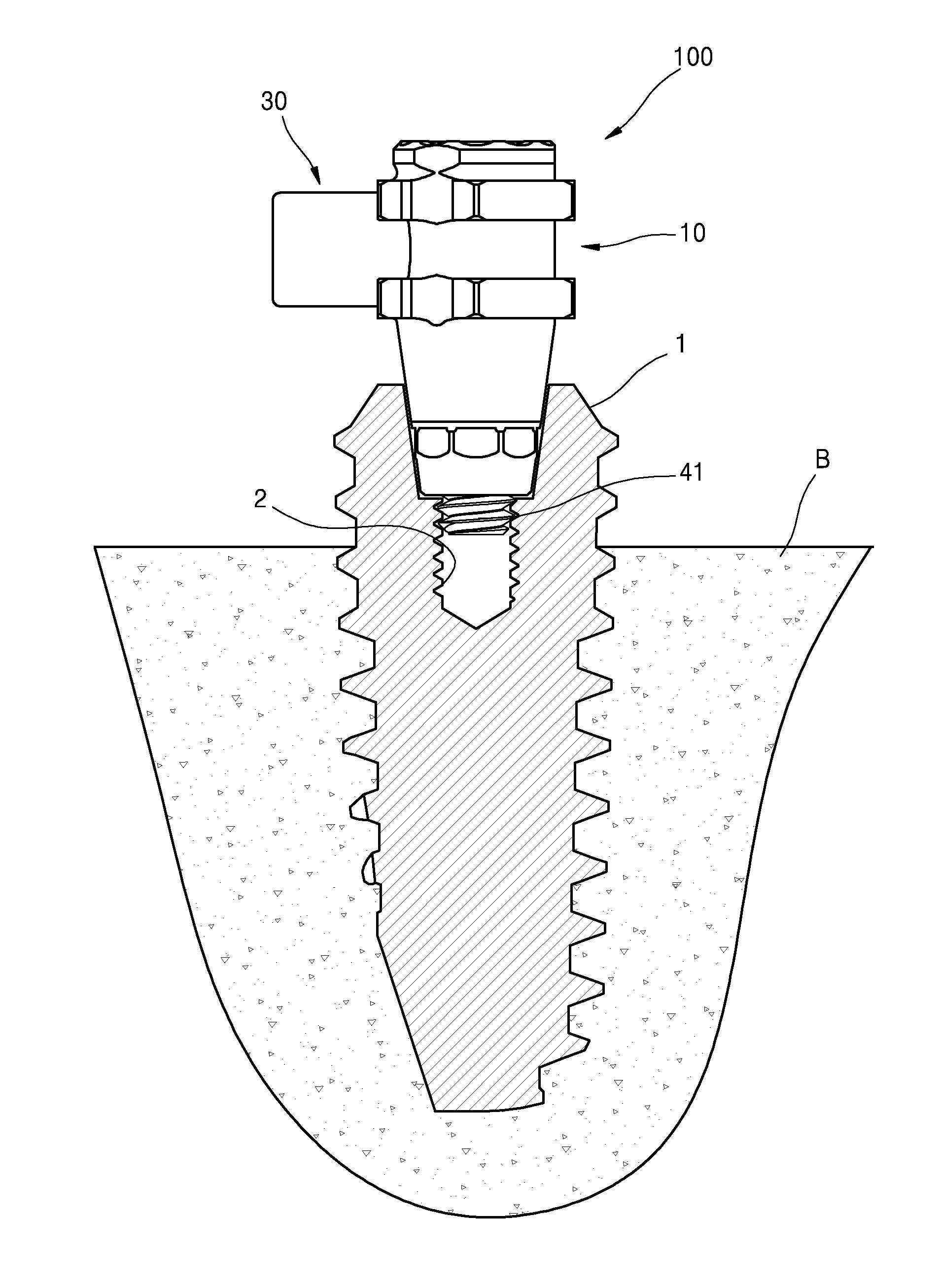 Implant Abutment