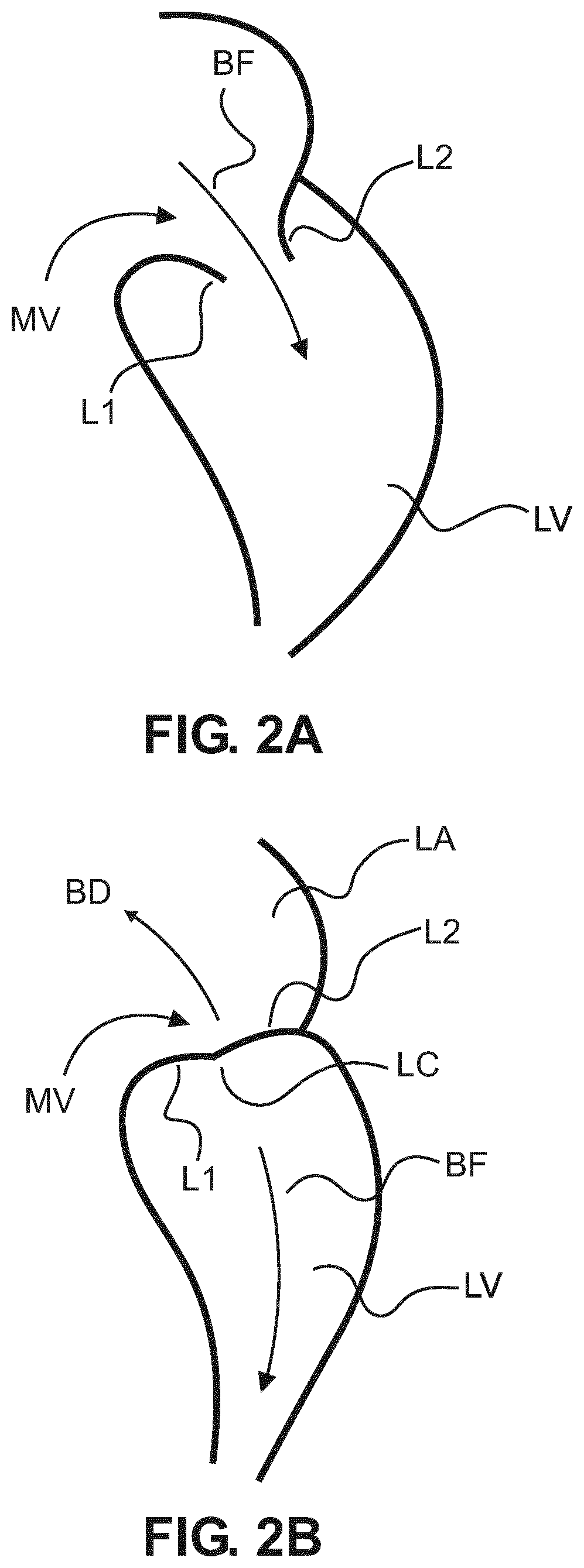 Signal-triggered interventional device control