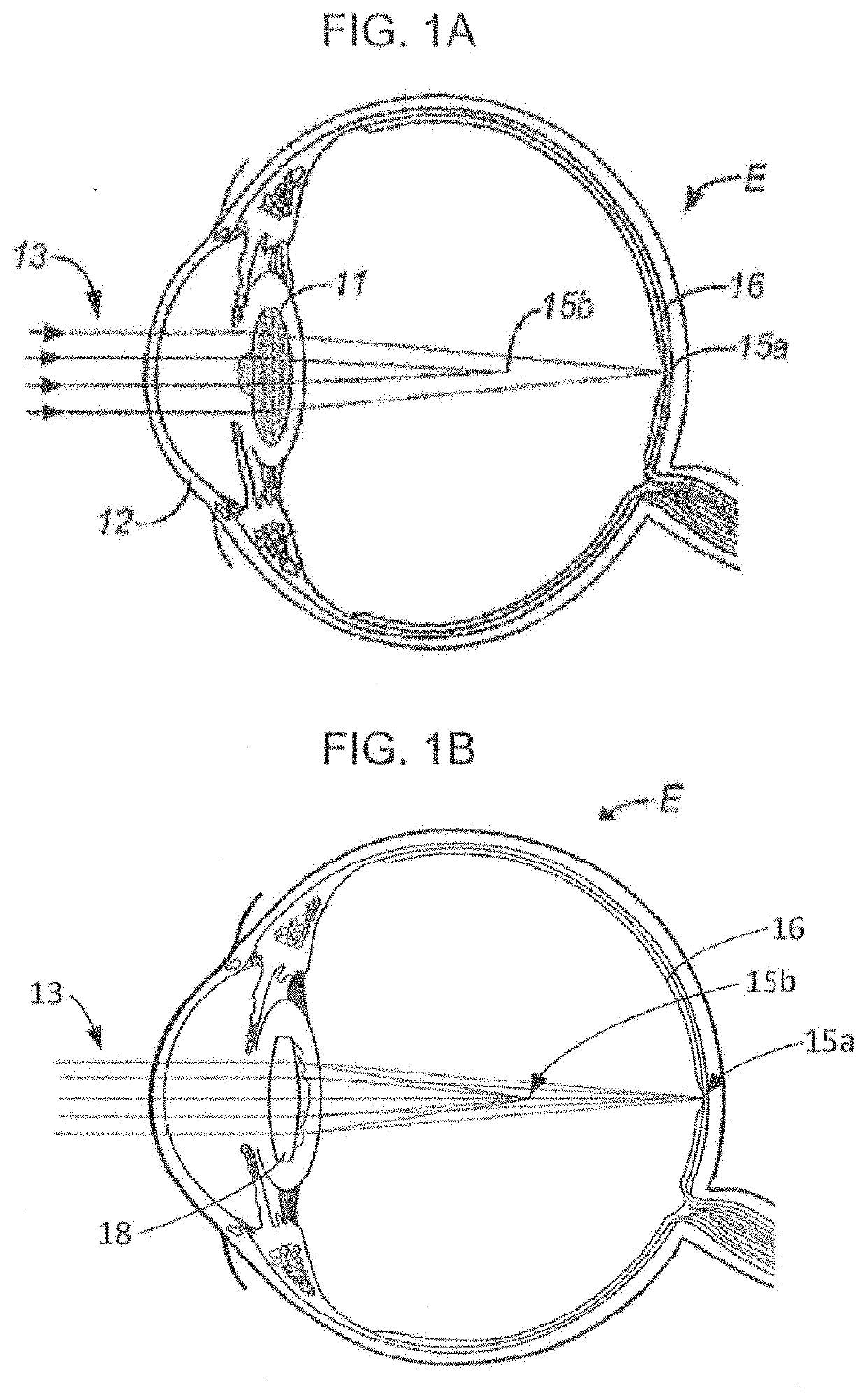 Achromatic lenses with zone order mixing for vision treatment