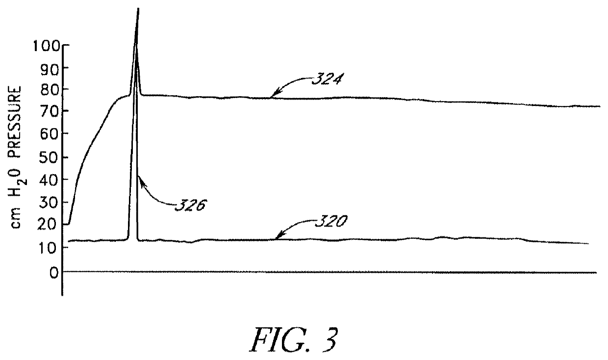Method of removing an inflated implant from a bladder