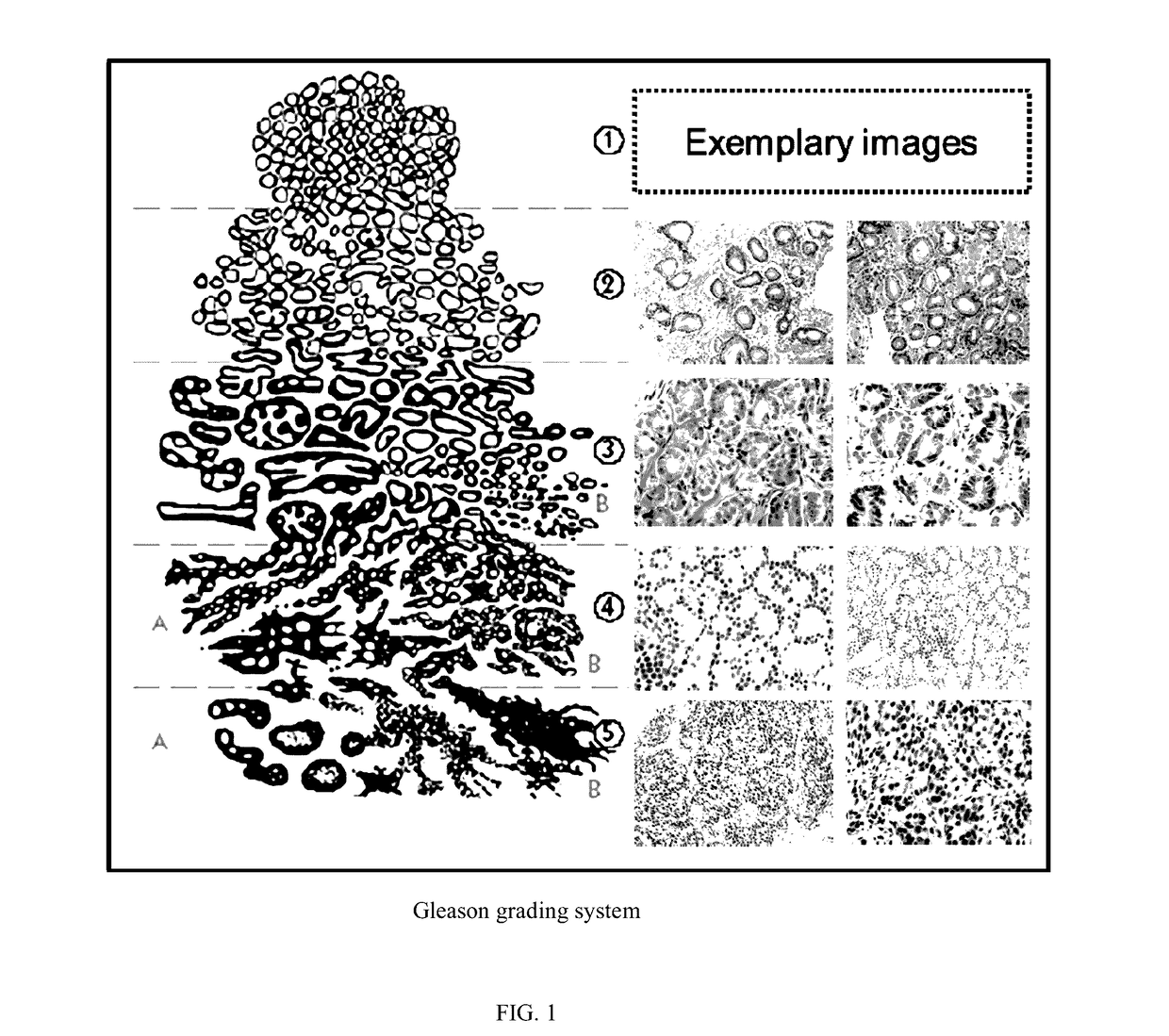 Systems and methods for automated screening and prognosis of cancer from whole-slide biopsy images