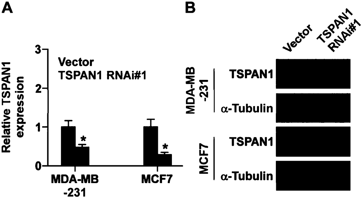 Application of TSPAN1 in diagnosis, prognosis and treatment of breast cancer metastasis