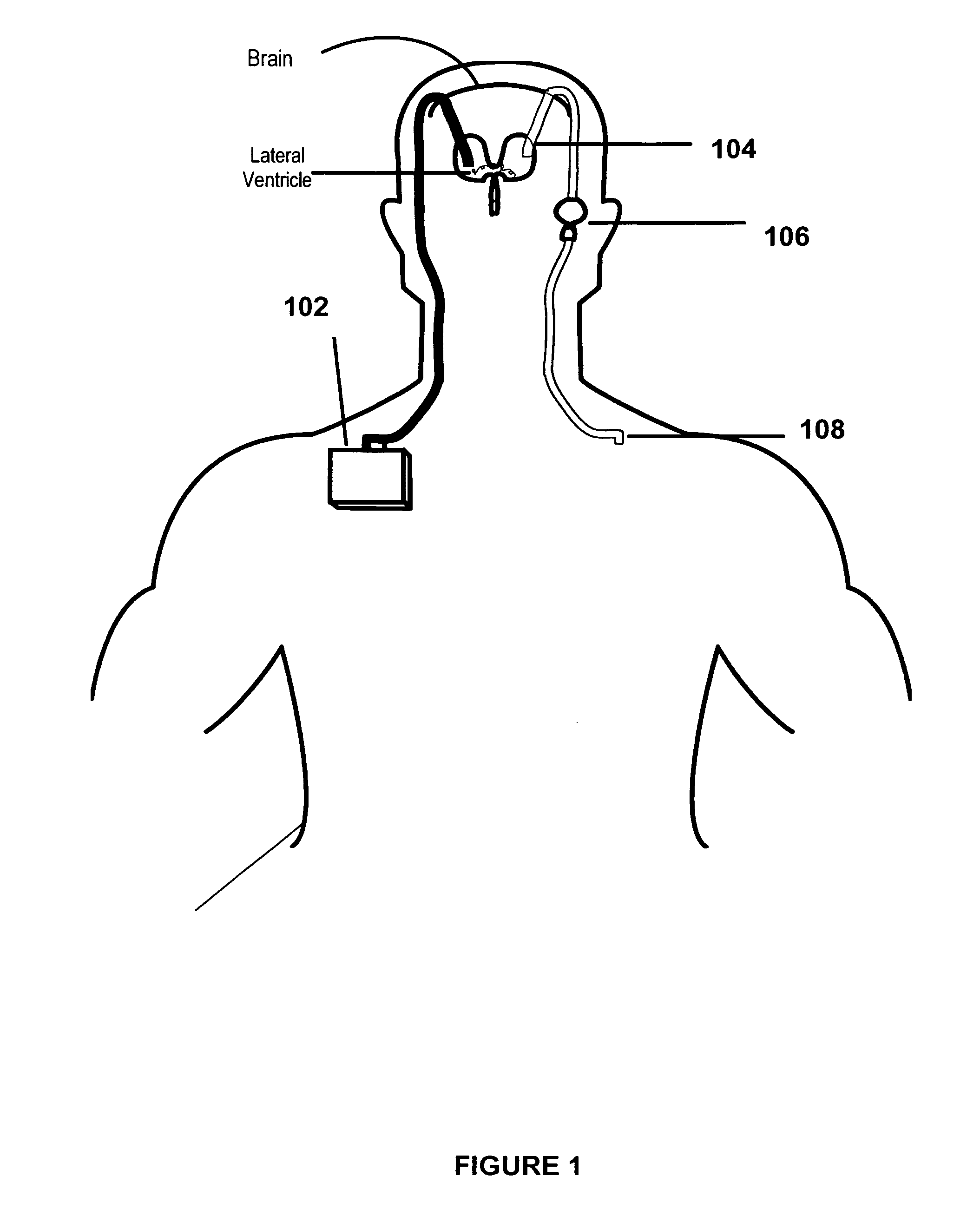 Method and apparatus for removing harmful proteins from a mammalian's ventricular cerebrospinal fluid