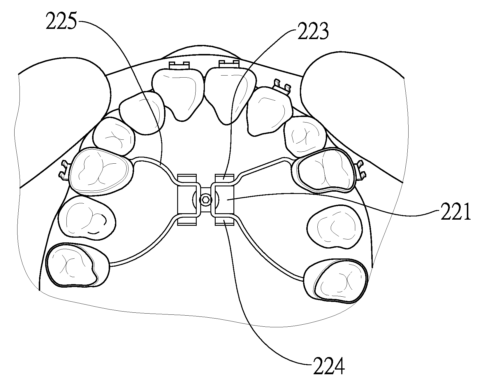 Orthodontic Maxillary Micro Implant