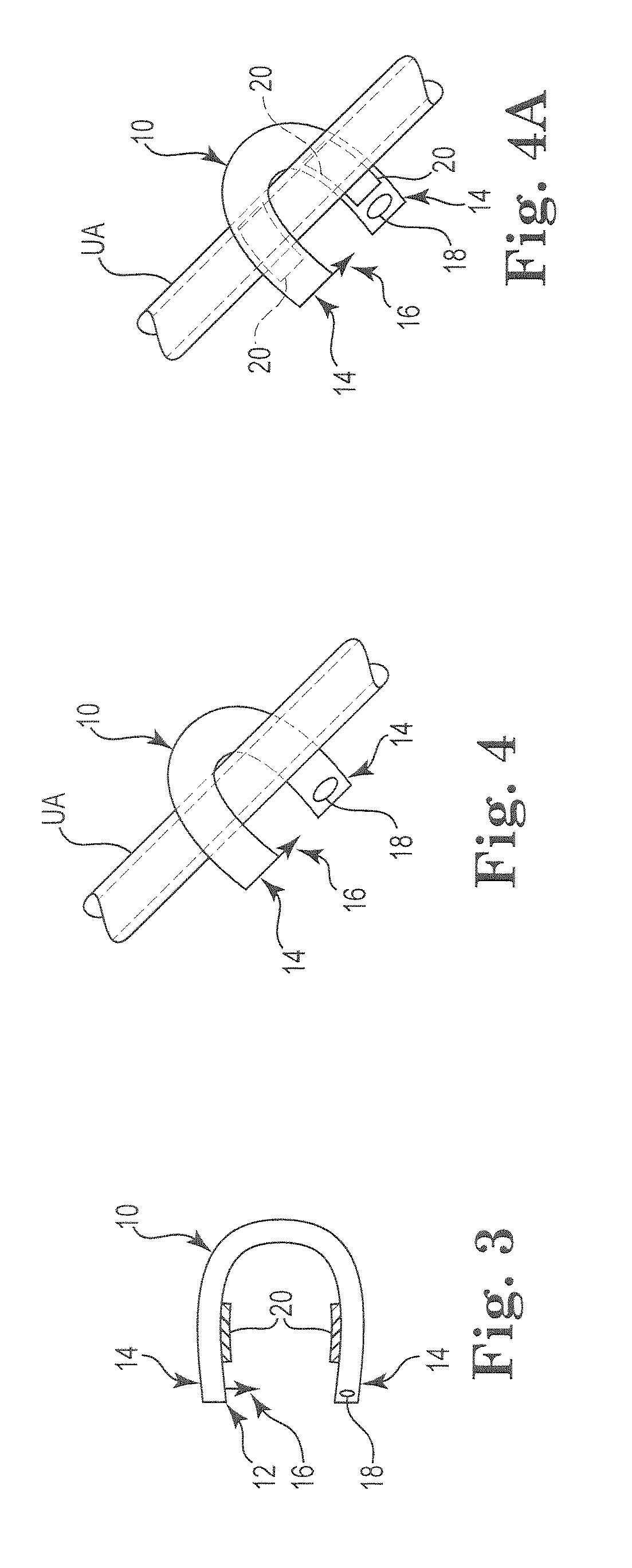 Fibroid Treatment System and Method