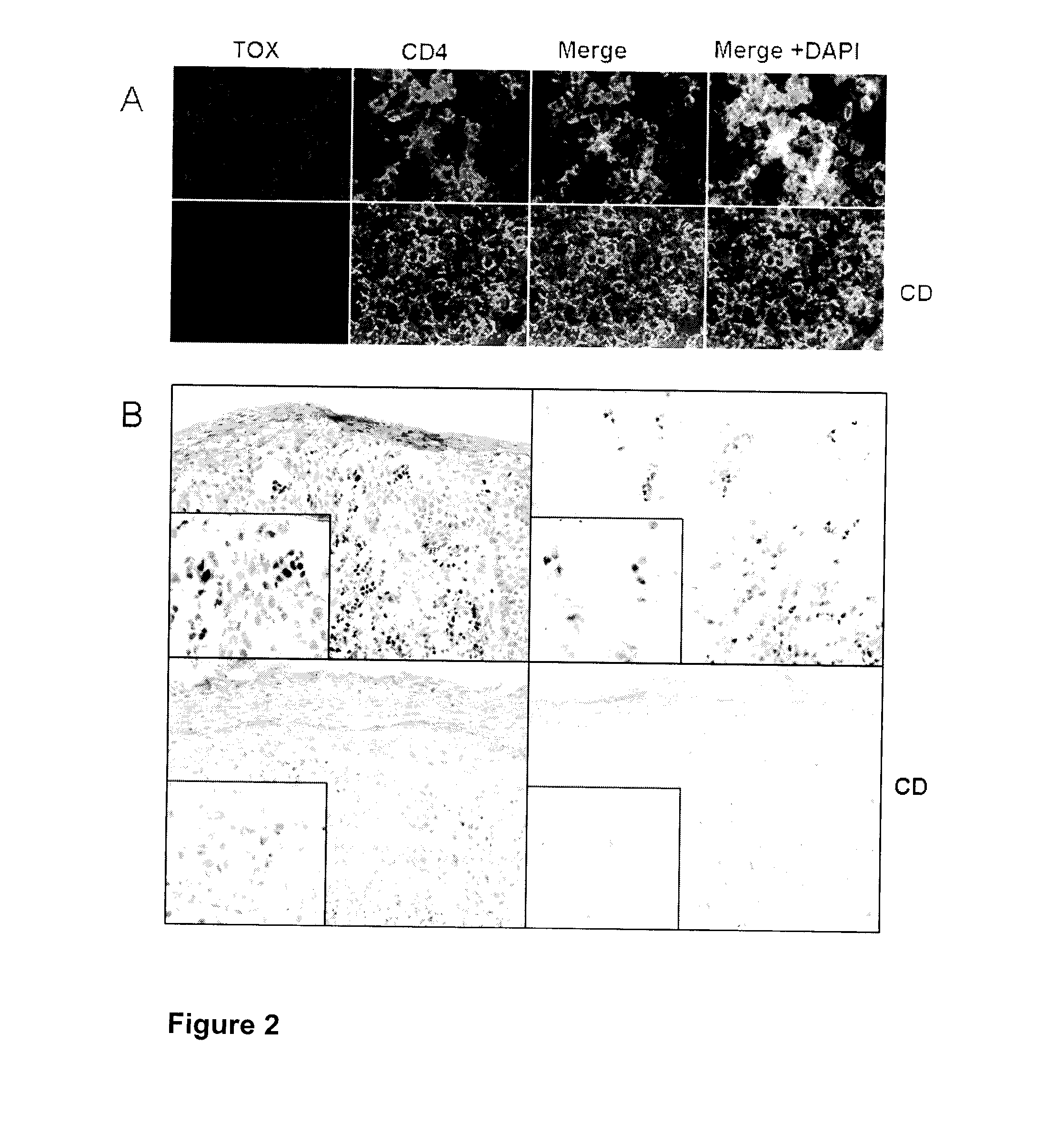 Biomarkers for t cell malignancies and uses thereof