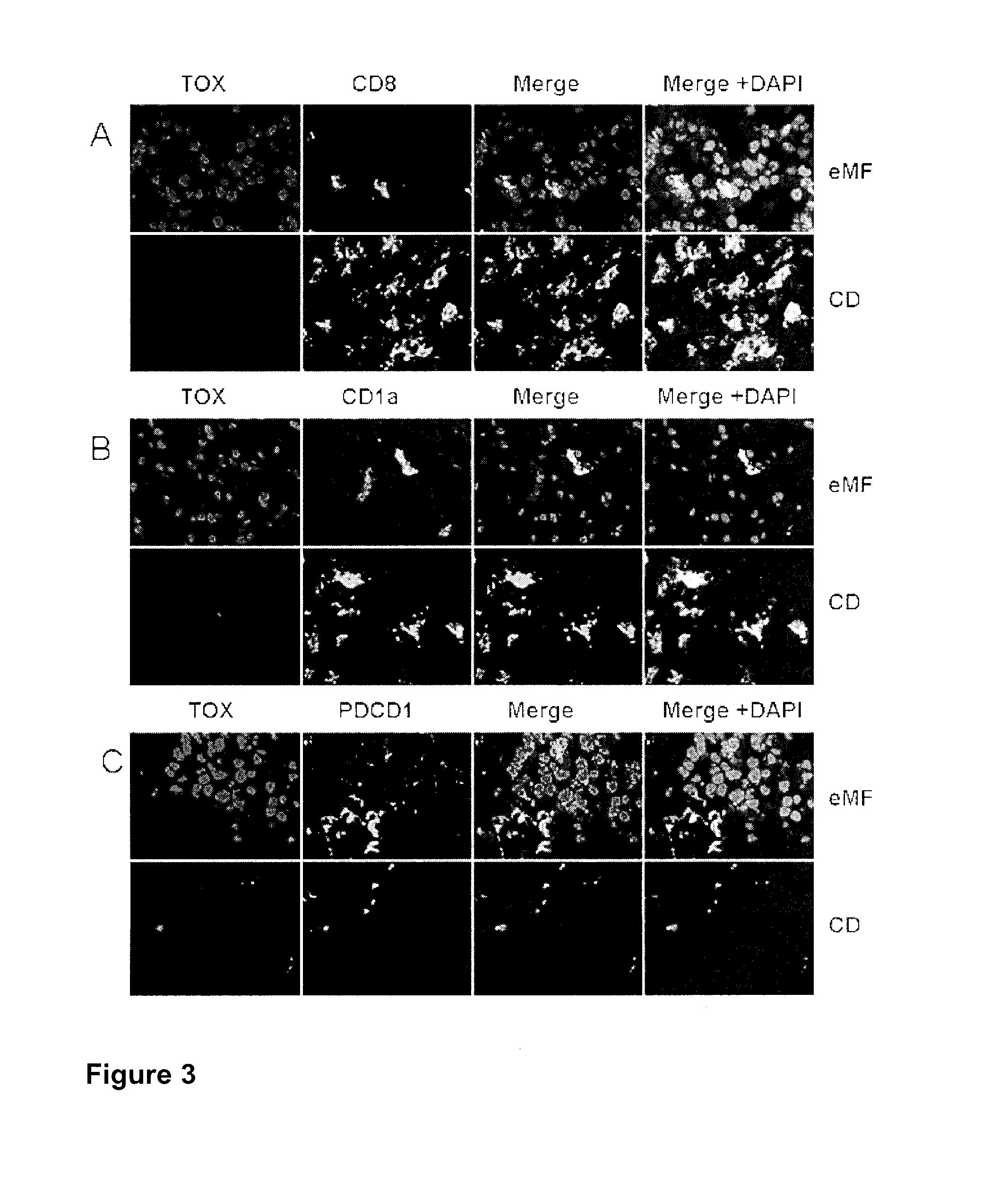 Biomarkers for t cell malignancies and uses thereof