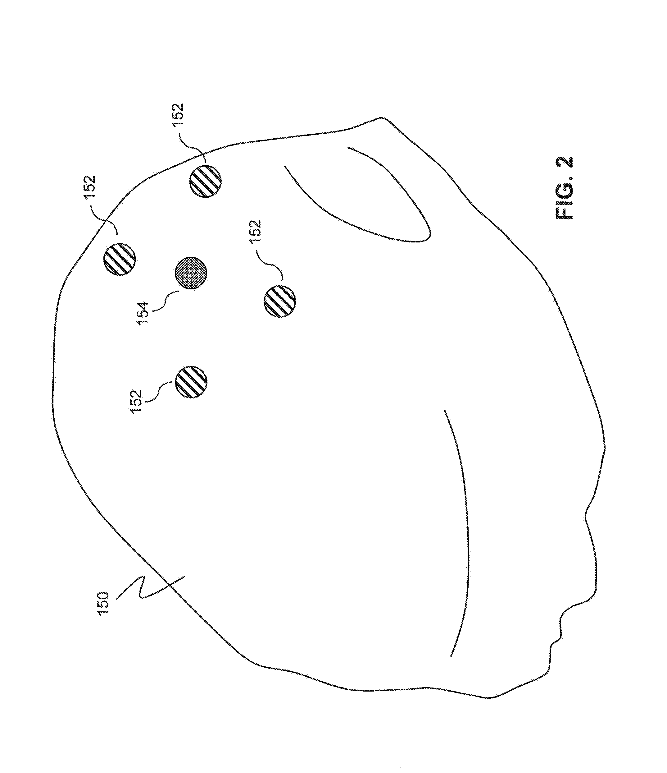 Wearable, unsupervised transcranial direct current stimulation (tDCS) device for movement disorder therapy, and method of using
