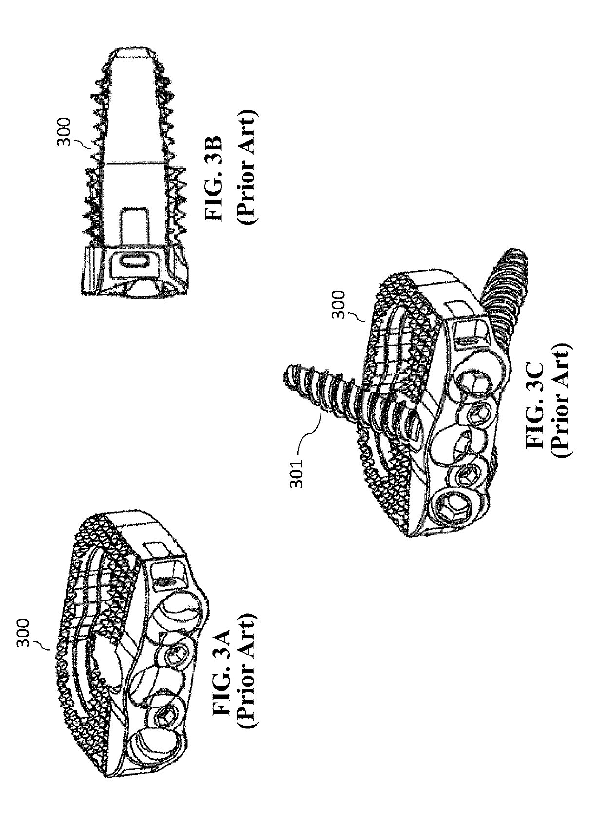 Medical implant having an anchoring system and method of use thereof