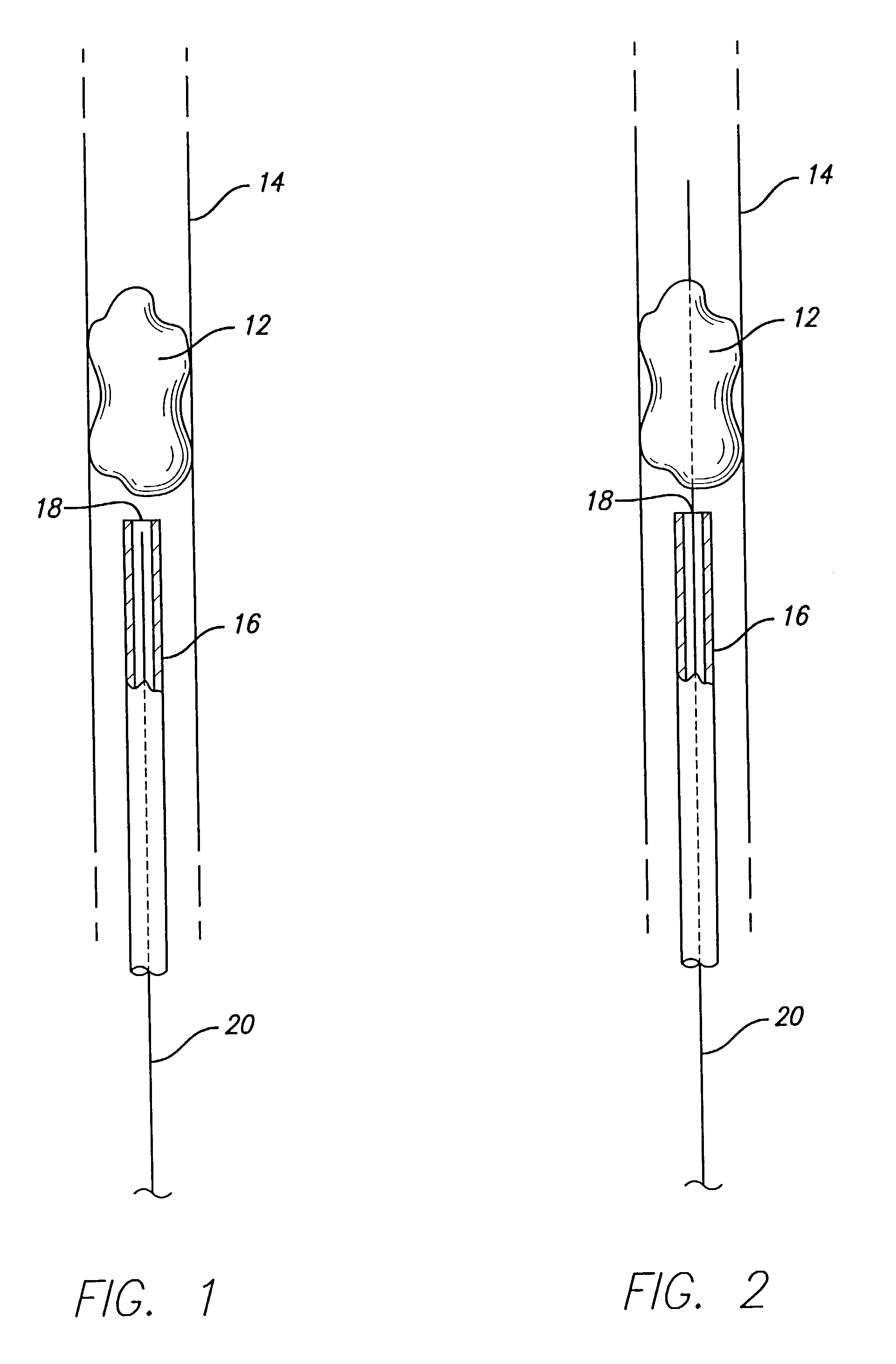 Device for removal of thrombus through physiological adhesion