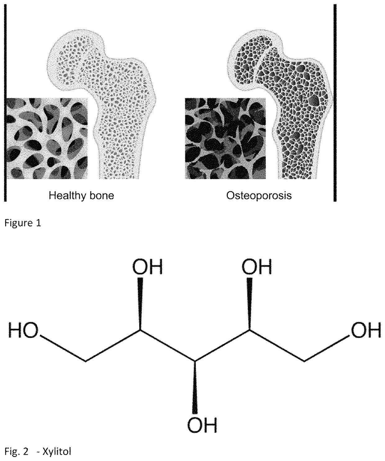 Method and system for reducing the likelihood of osteoporosis