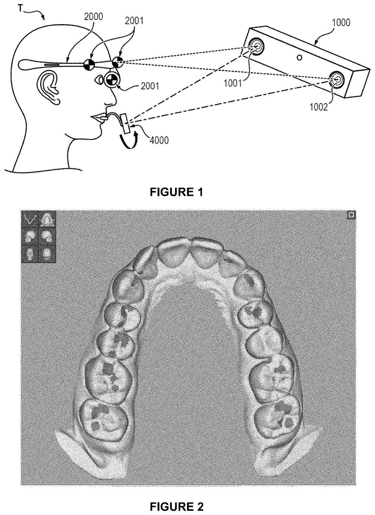 Method for determining a mapping of the contacts and/or distances between the maxillary and mandibular arches of a patient