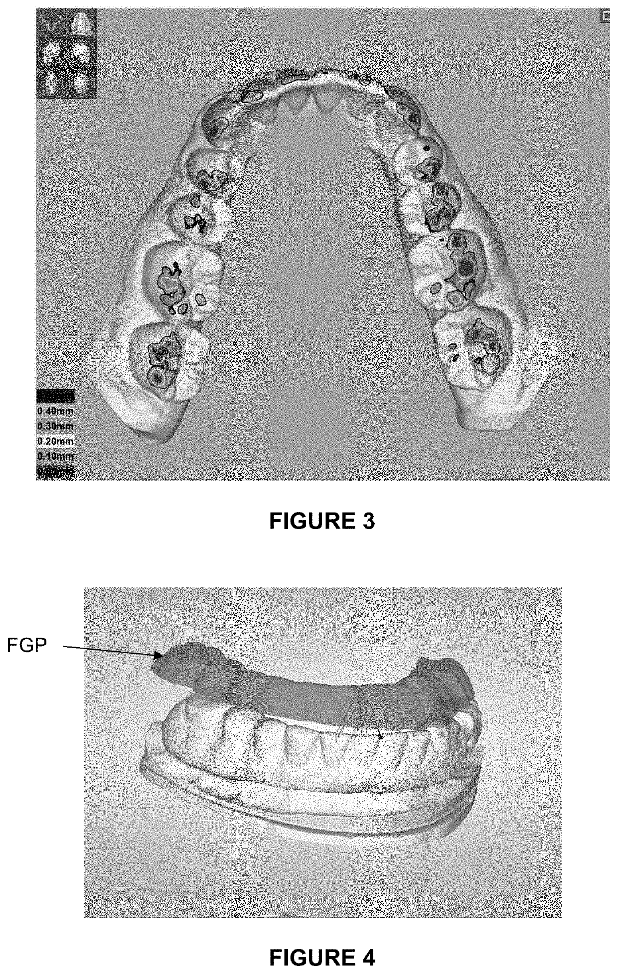 Method for determining a mapping of the contacts and/or distances between the maxillary and mandibular arches of a patient