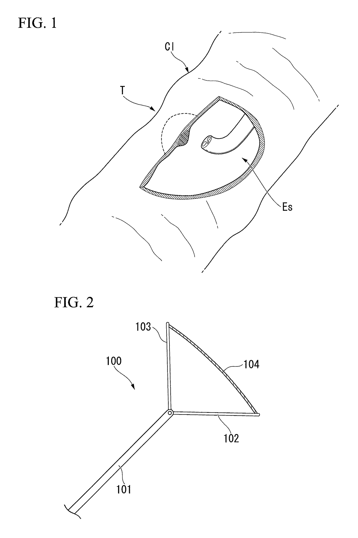 Method for tissue resection