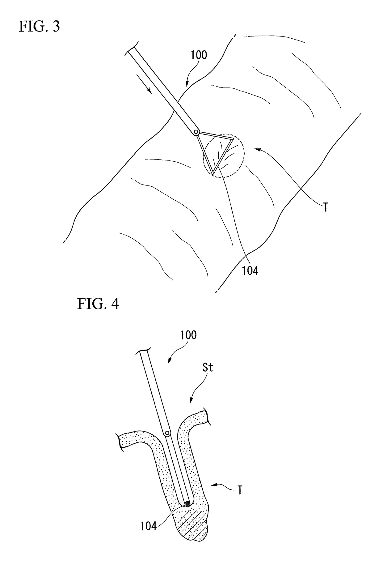 Method for tissue resection