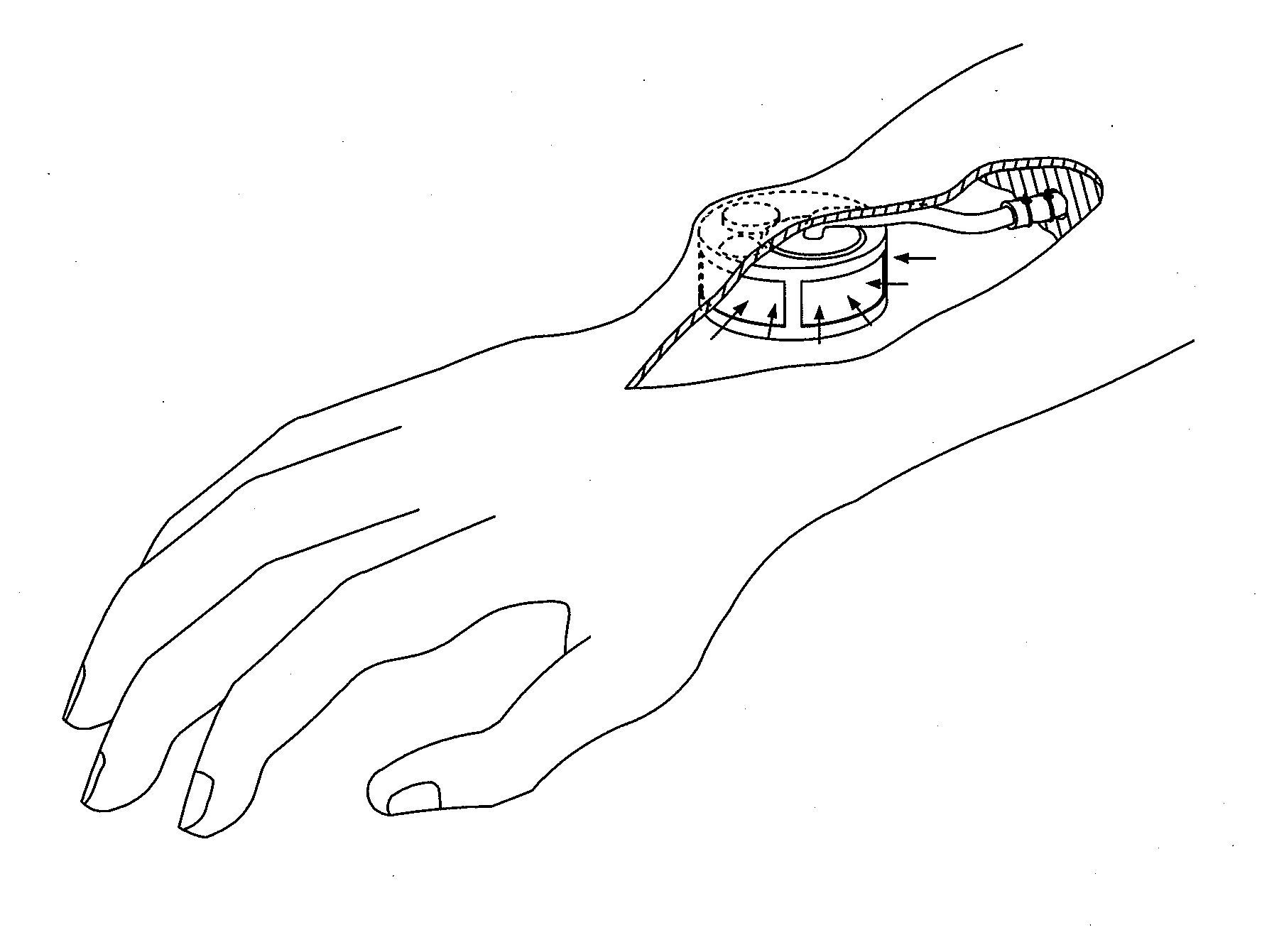 Device for draining lymph into vein