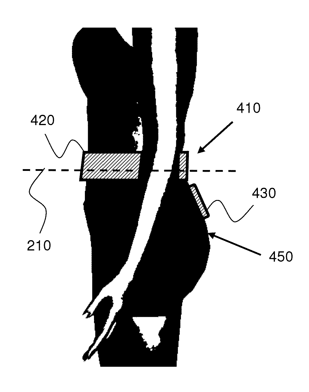 Wearable antenna assembly for an in-VIVO device
