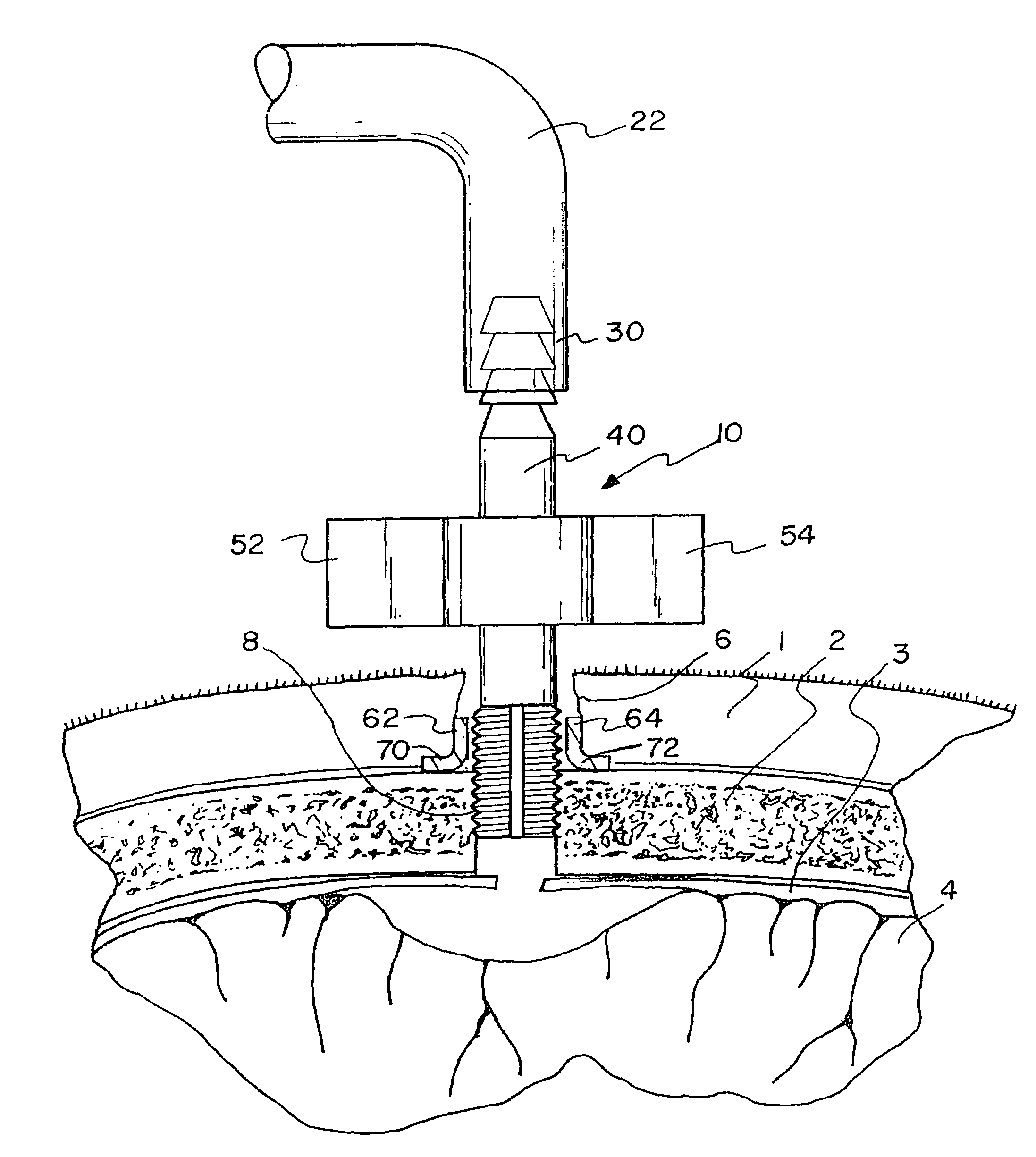 Subdural evacuating port system