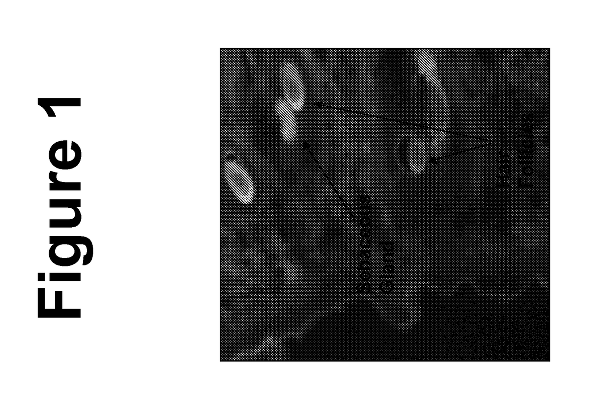 Methods of treating acne using nanoemulsion compositions