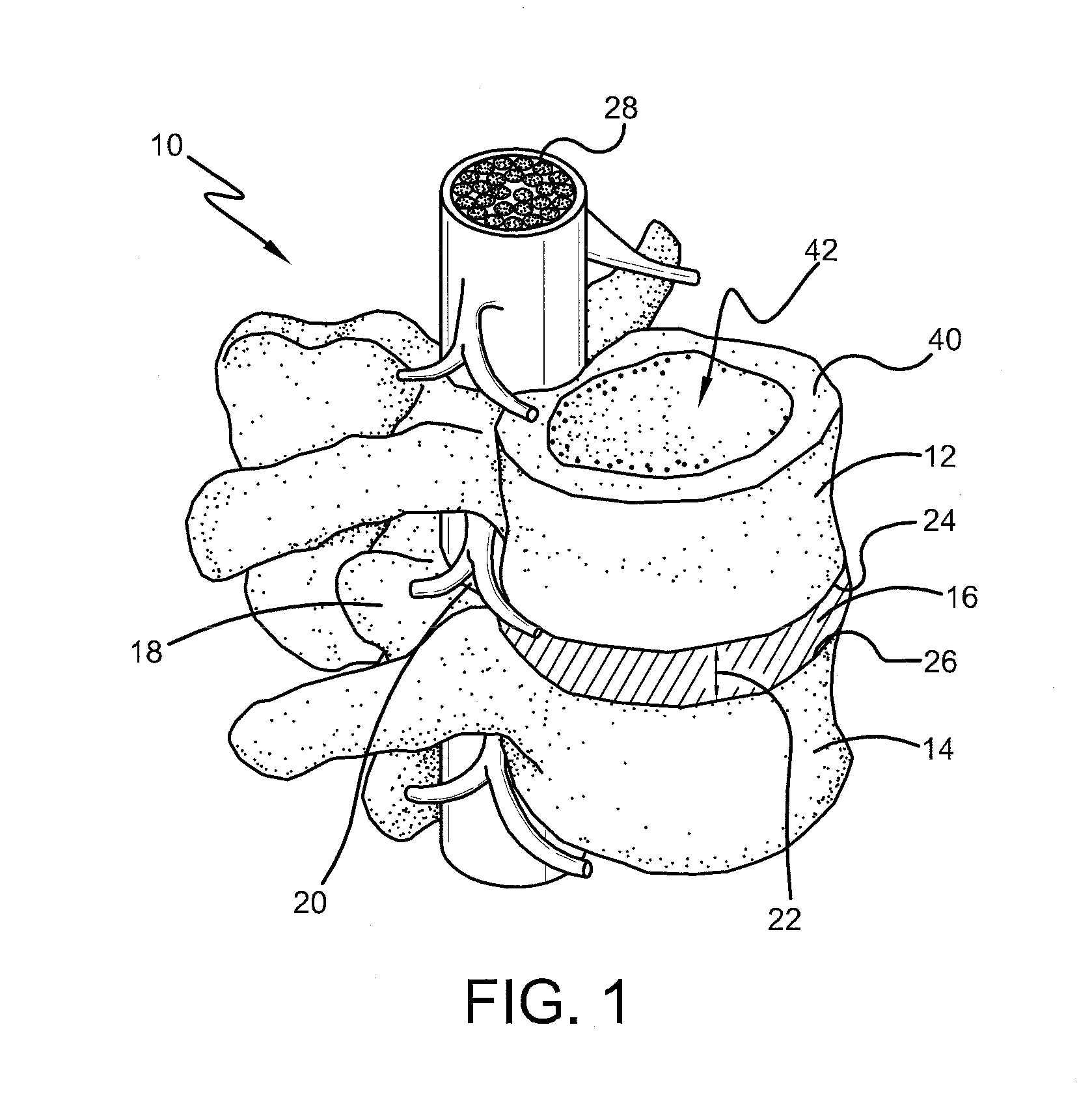 Spine surgery method and implant deployment