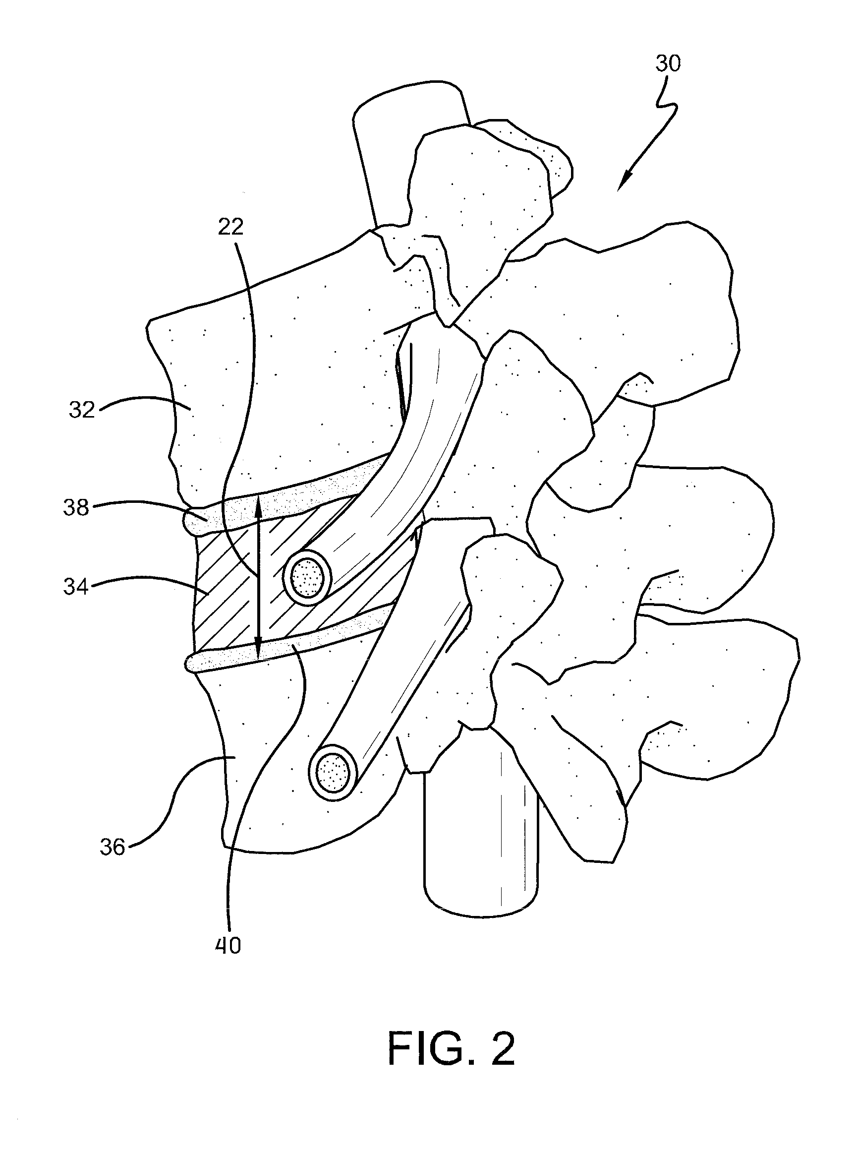 Spine surgery method and implant deployment