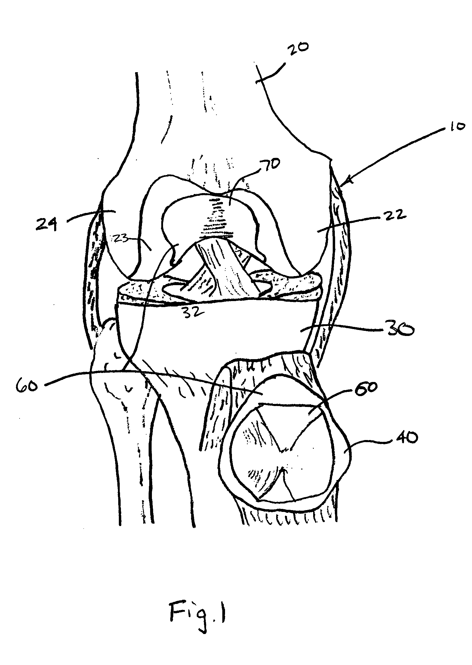 Patello-femoral prosthesis