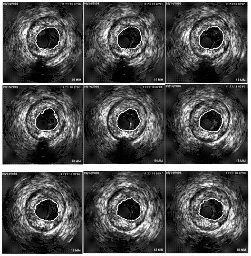 Blood vessel ROI dividing method based on intravascular ultrasonic image
