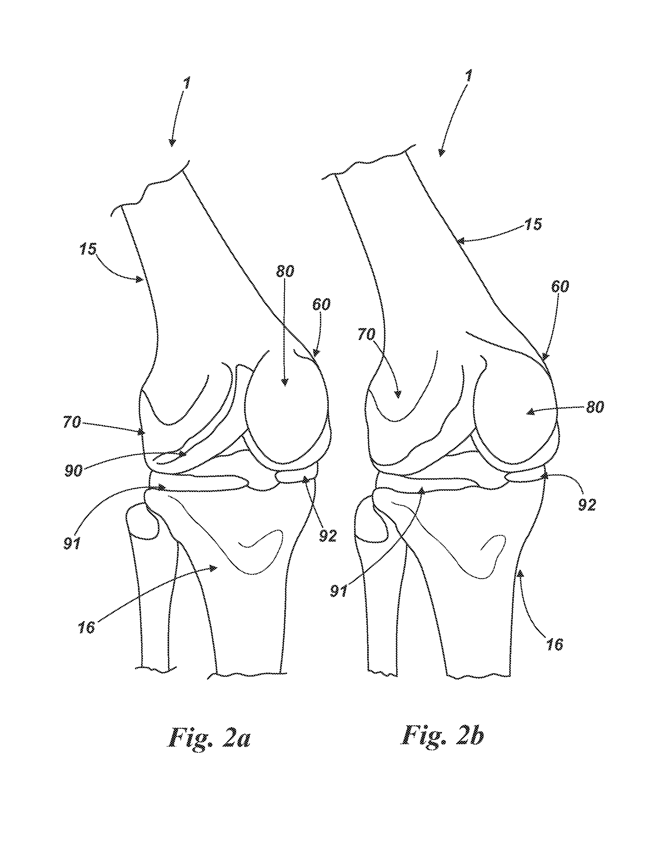 Method of implanting a unicondylar knee prosthesis