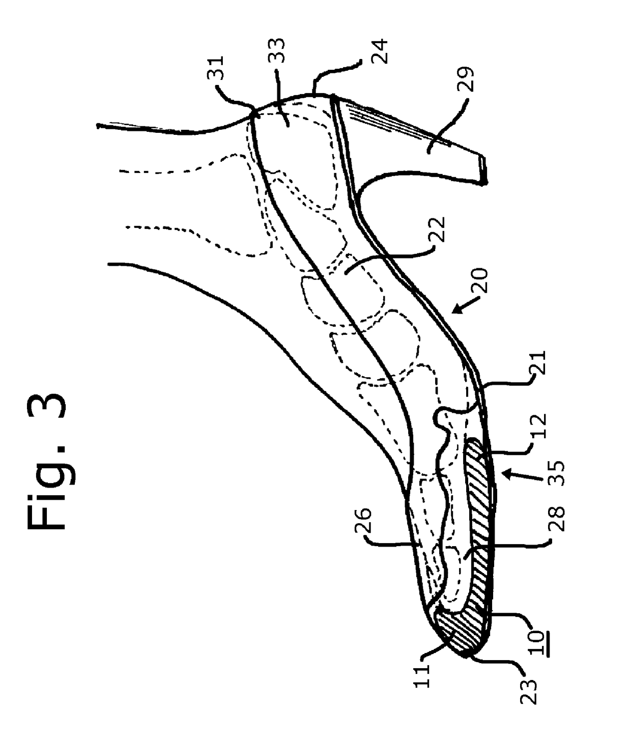 Removable shoe insert for corrective sizing
