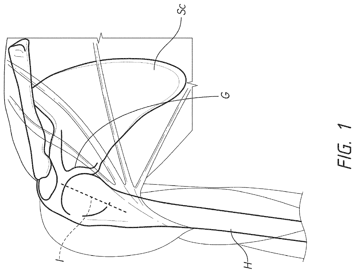 Stemless prosthesis anchor components and kits