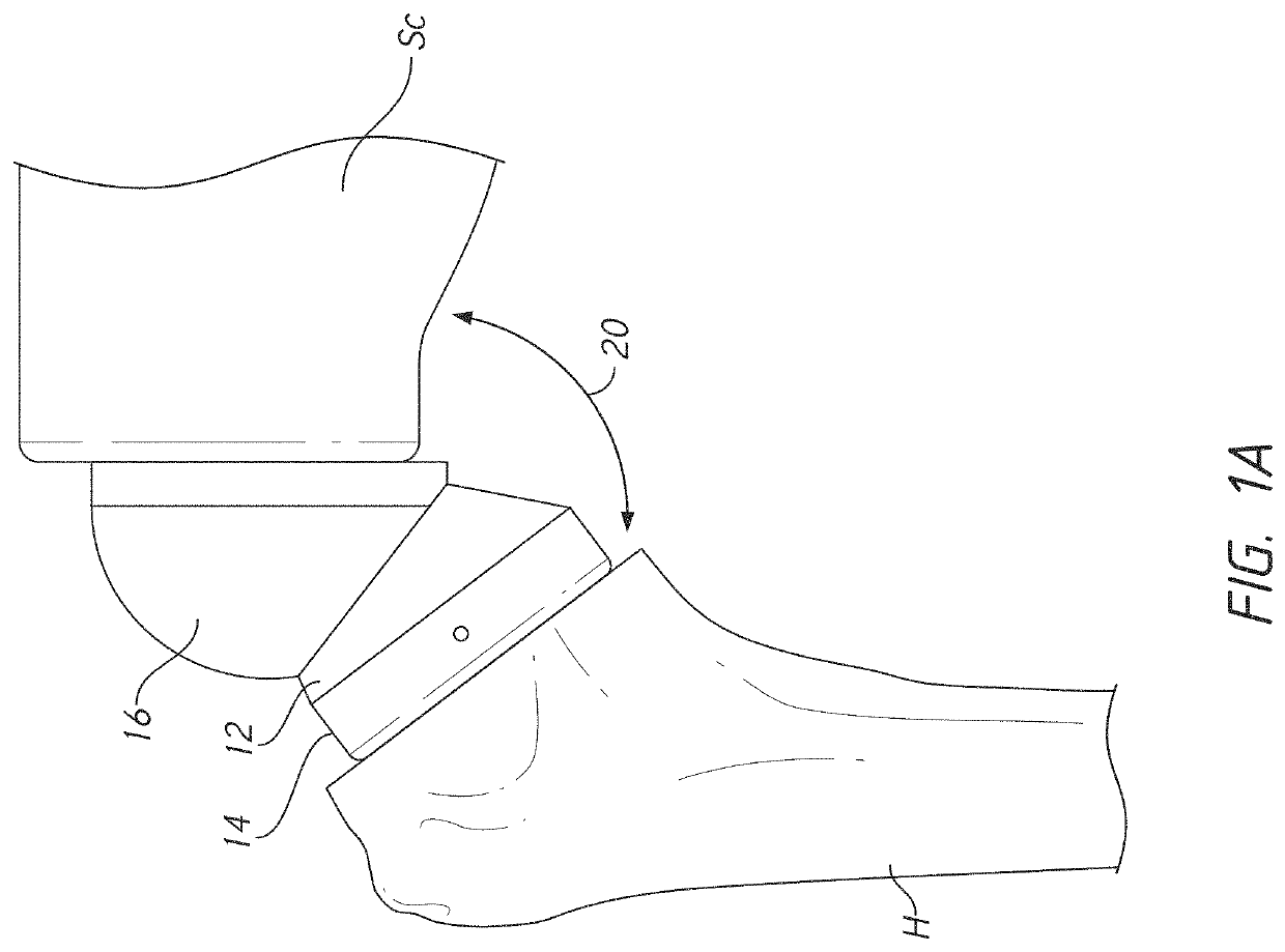 Stemless prosthesis anchor components and kits