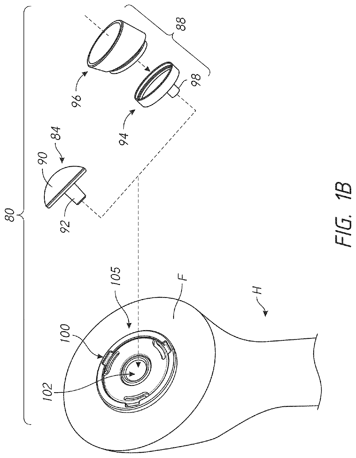 Stemless prosthesis anchor components and kits