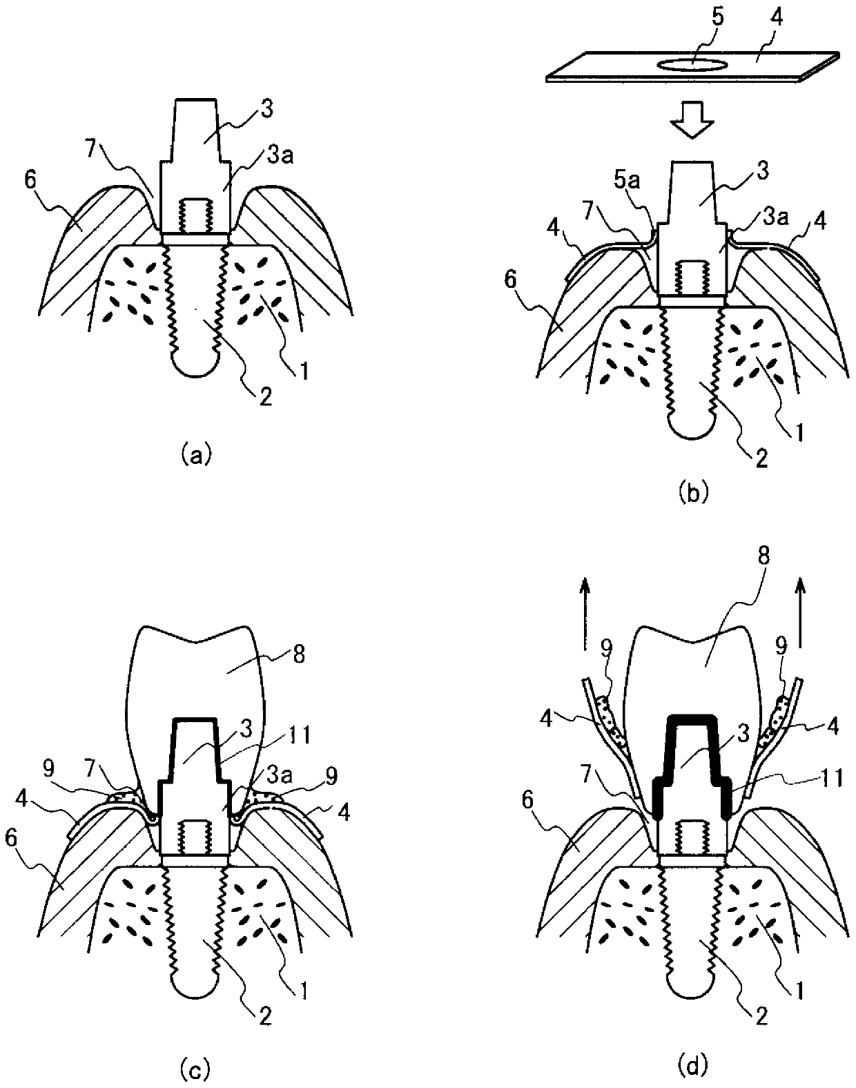 Method for using sheet to prevent inflammation caused by excess dental cement and Anti-inflammatory sheet