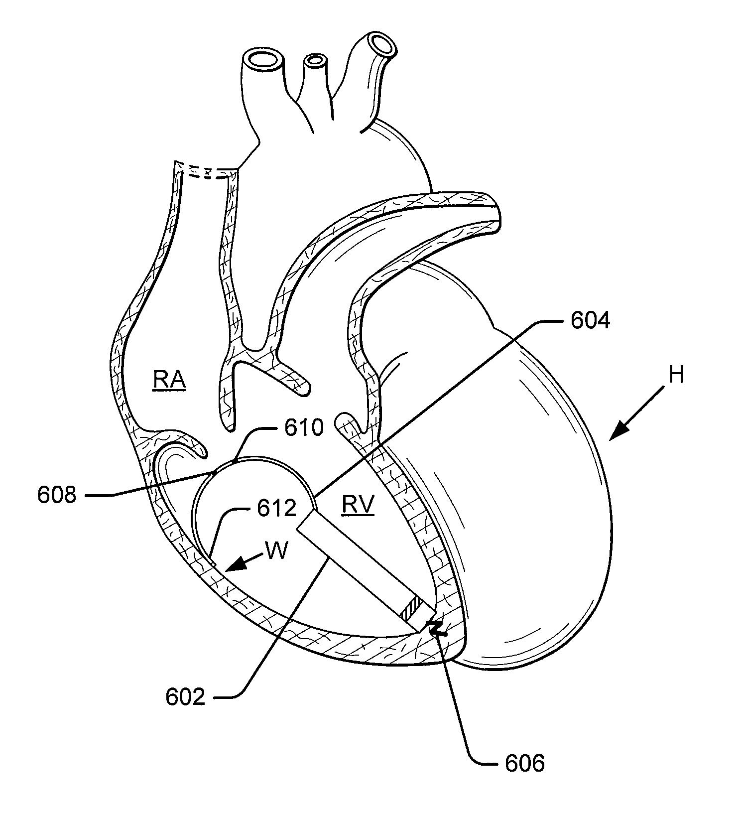 Leadless intra-cardiac medical device with dual chamber sensing through electrical and/or mechanical sensing