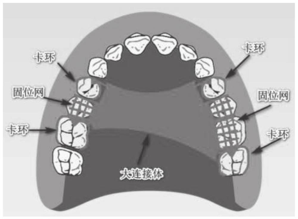 Automatic generation method and system for removable partial denture bracket model